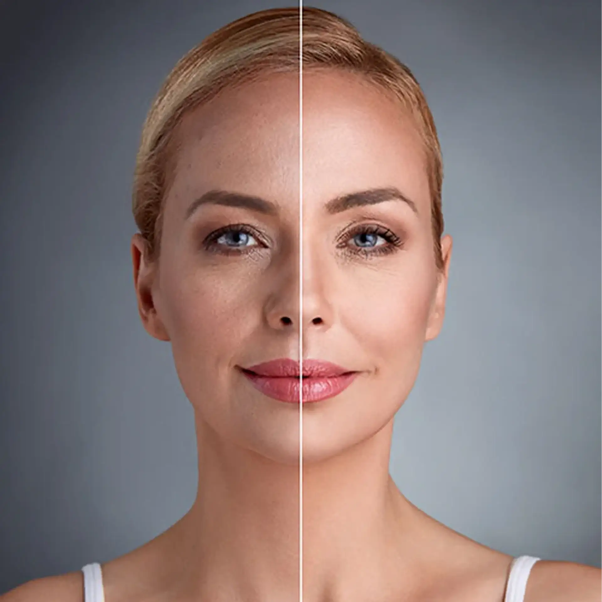 Benefits of fat grafting instead of using implants