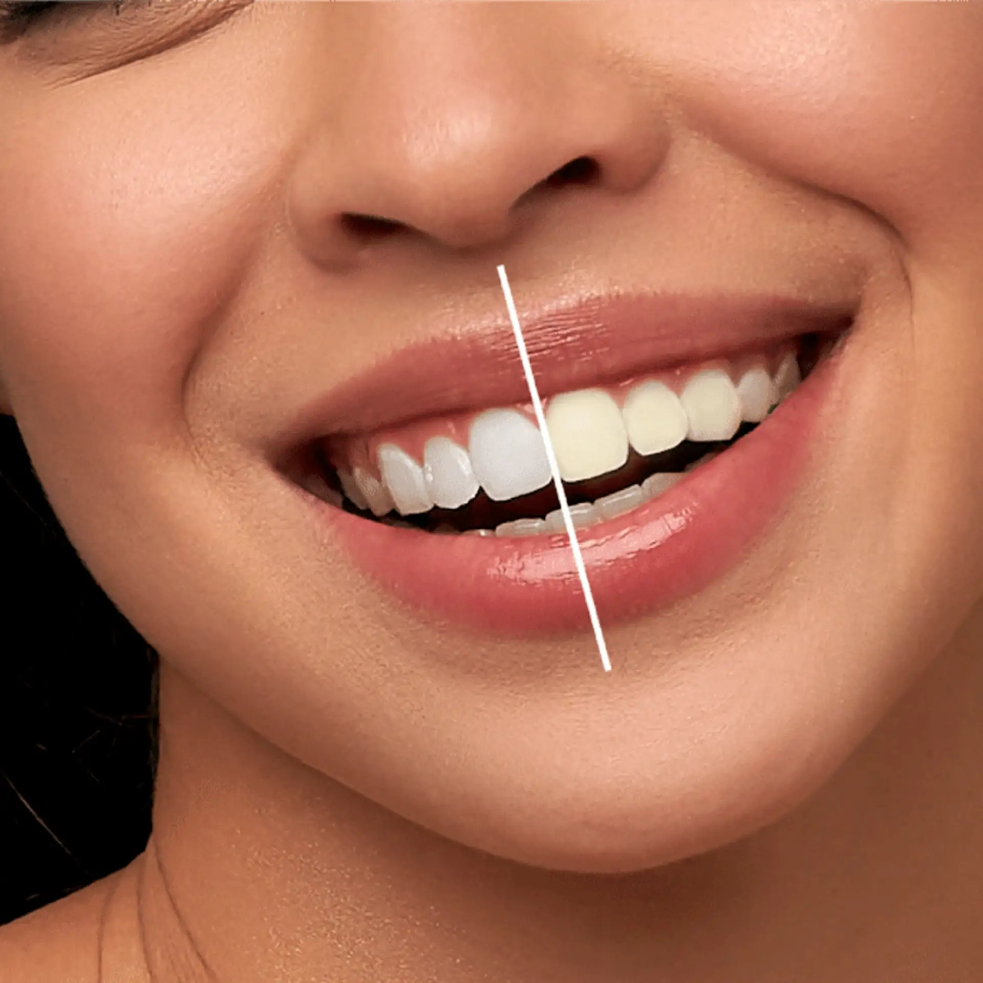 What Is Teeth Whitening