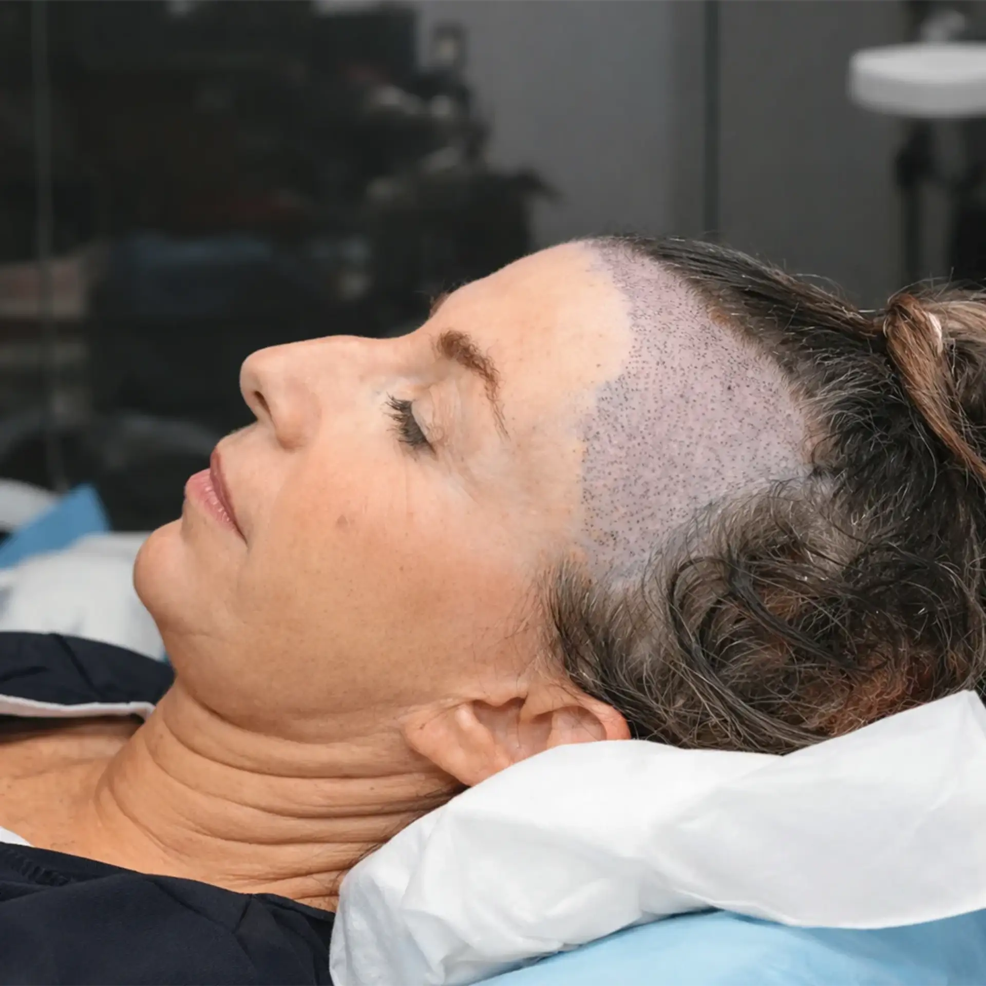 impact-hormonal-changes-pcod-on-density