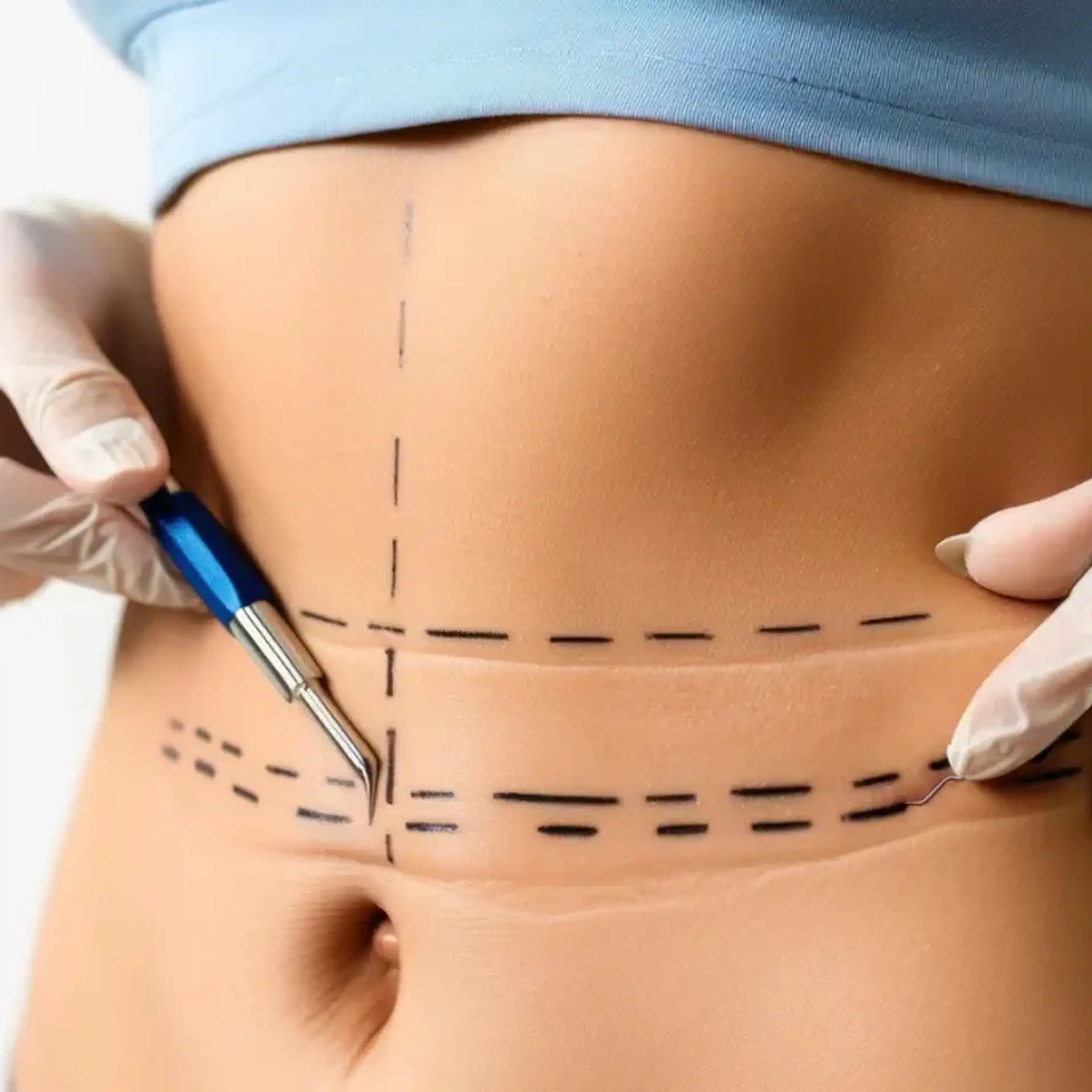 Before Liposuction