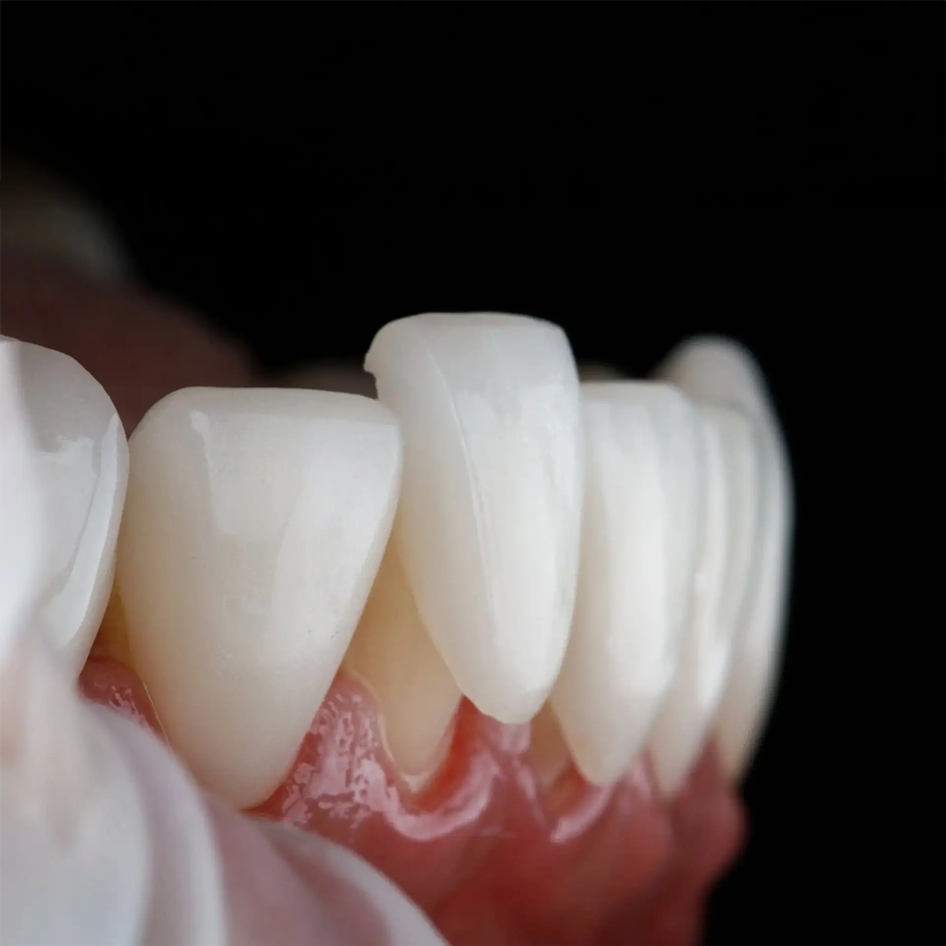 What Are Dental Veneers