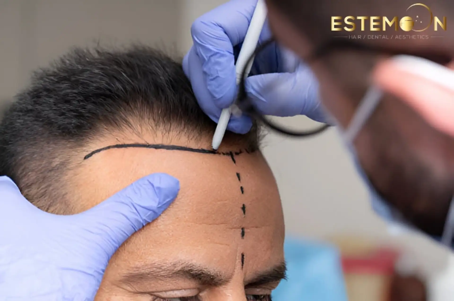 DHI Hair Transplant in Turkey Estemoon