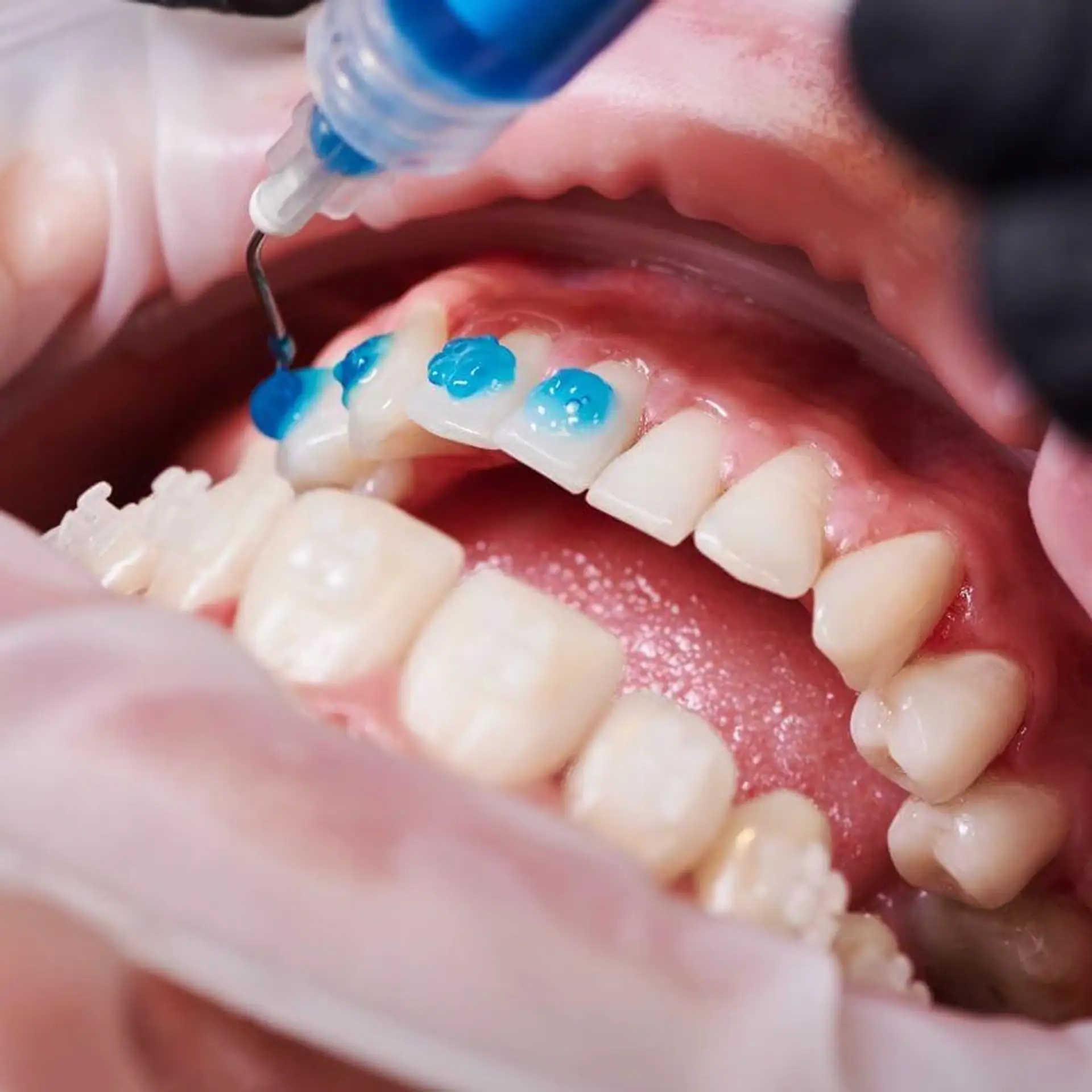 Teeth Whitening In Turkey