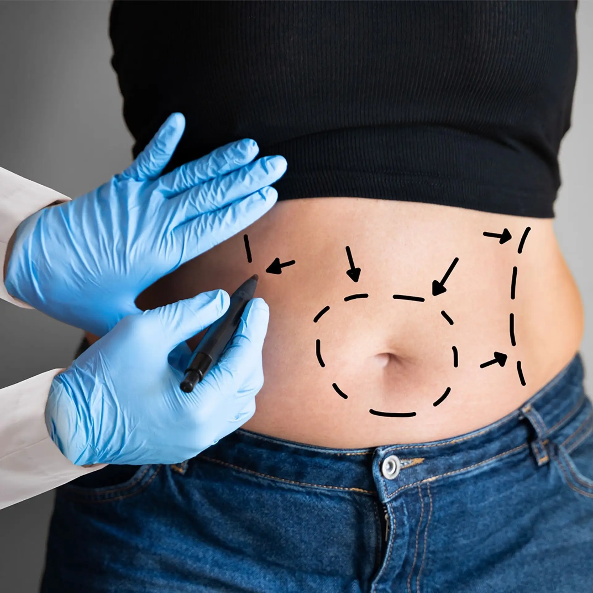 After Liposuction