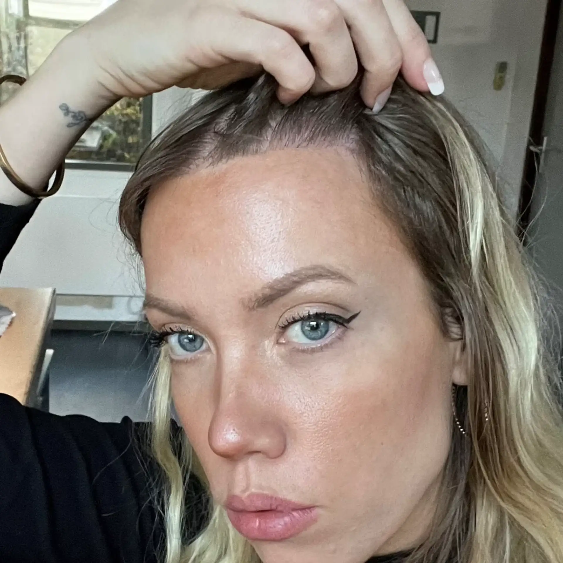 are-you-good-candidate-for-female-hair-transplant