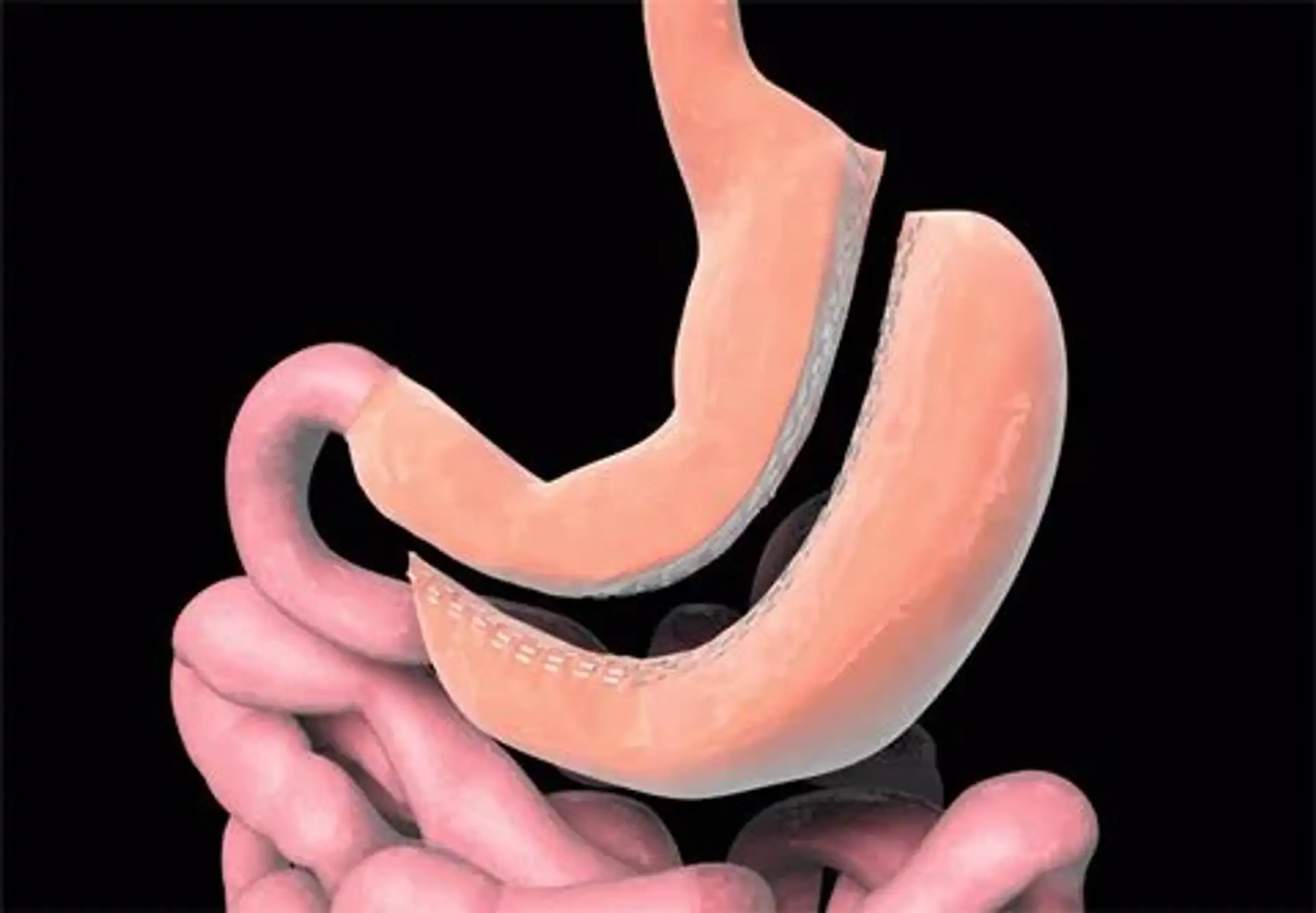 Understanding Sleeve Gastrectomy: Risks, Benefits and More