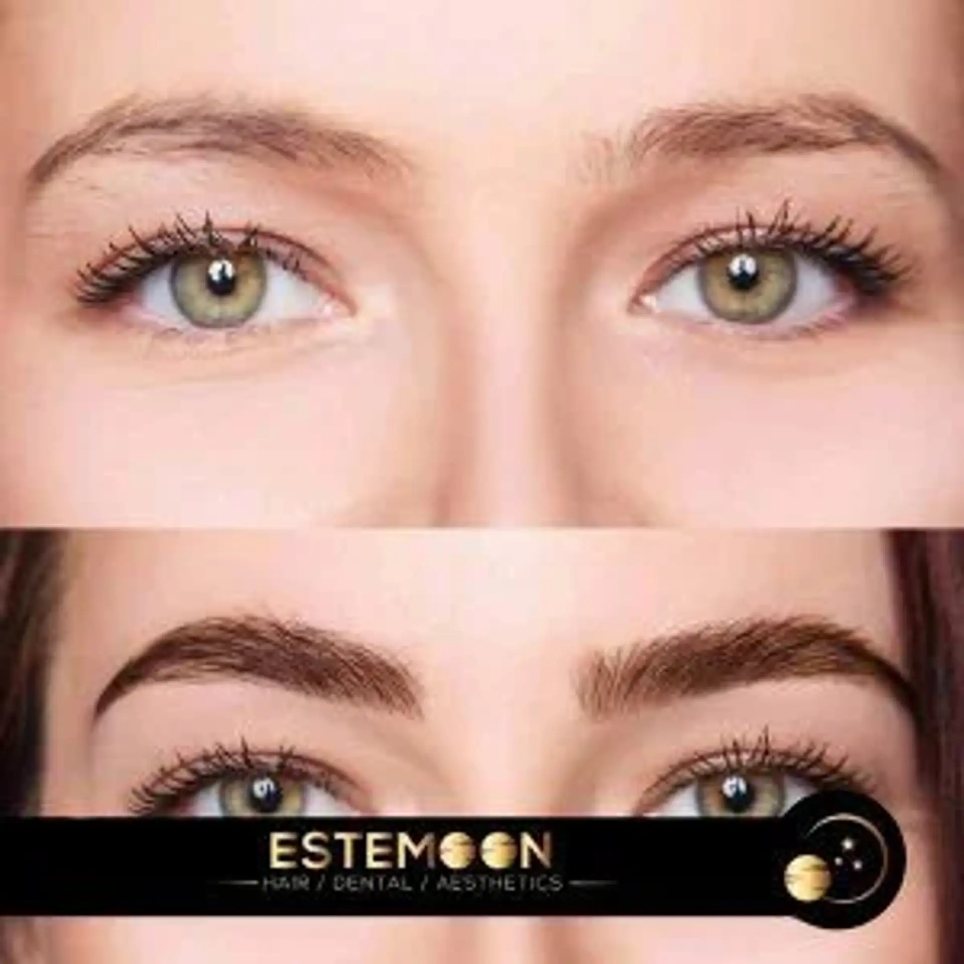 Eyebrow Transplant Before and After in Albania