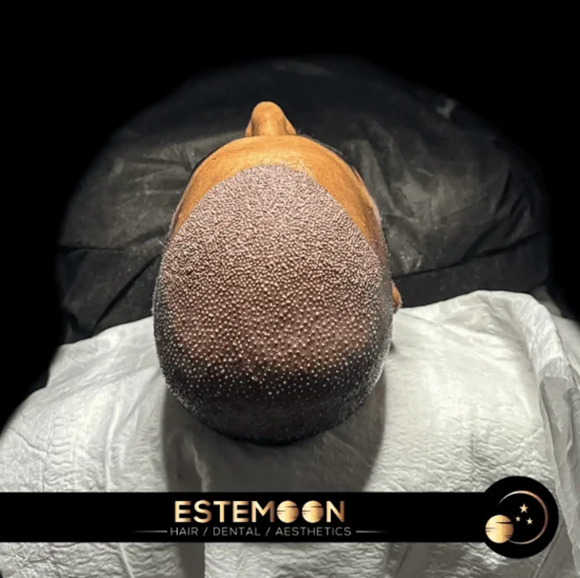 Body Hair to Head Transplant: A Revolutionary Solution