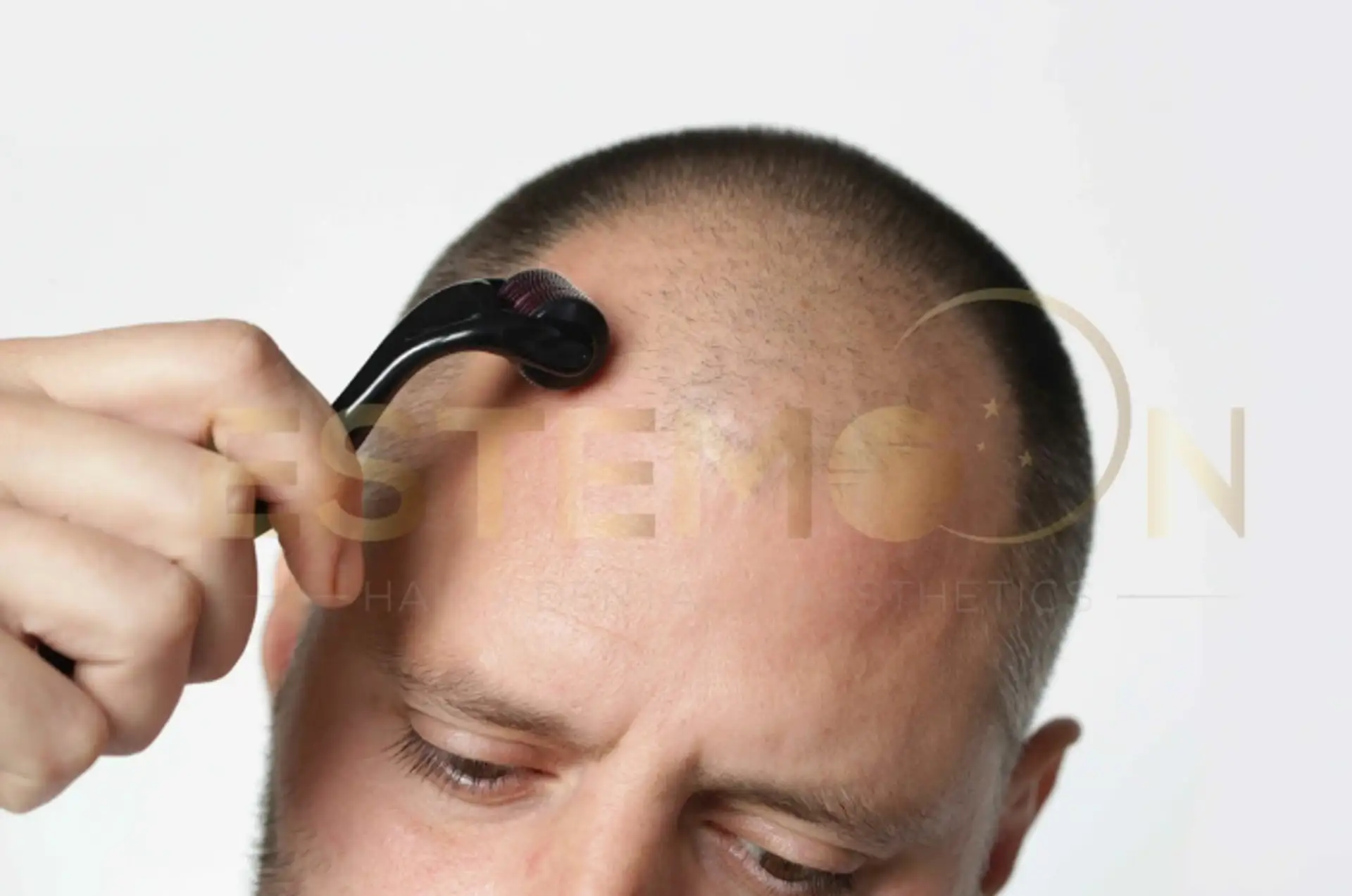 DIY Dermastamping and Minoxidil for Hair Growth – Science or Risk?