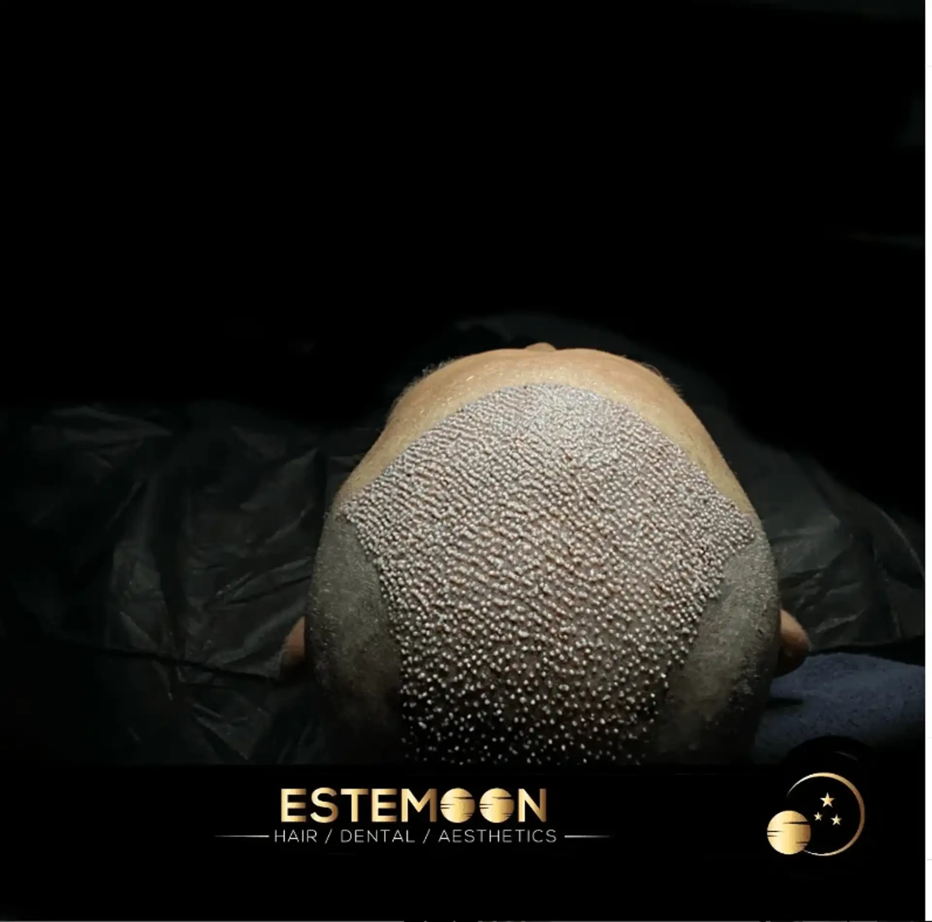FUE vs. FUT Hair Transplant