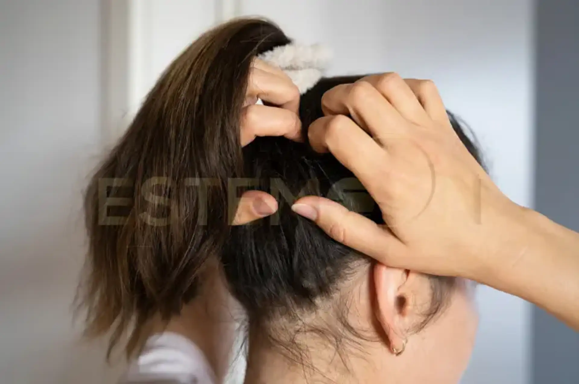 How to Fix Dry Scalp Effective Remedies and Prevention