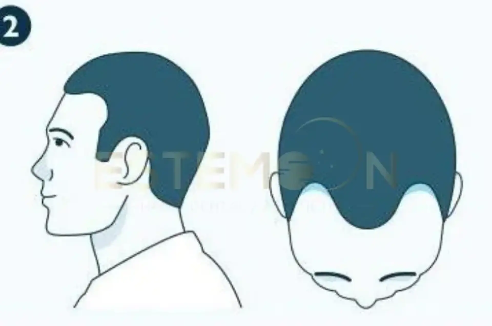 Norwood 2 Hair loss Treatments Transplant Options Results