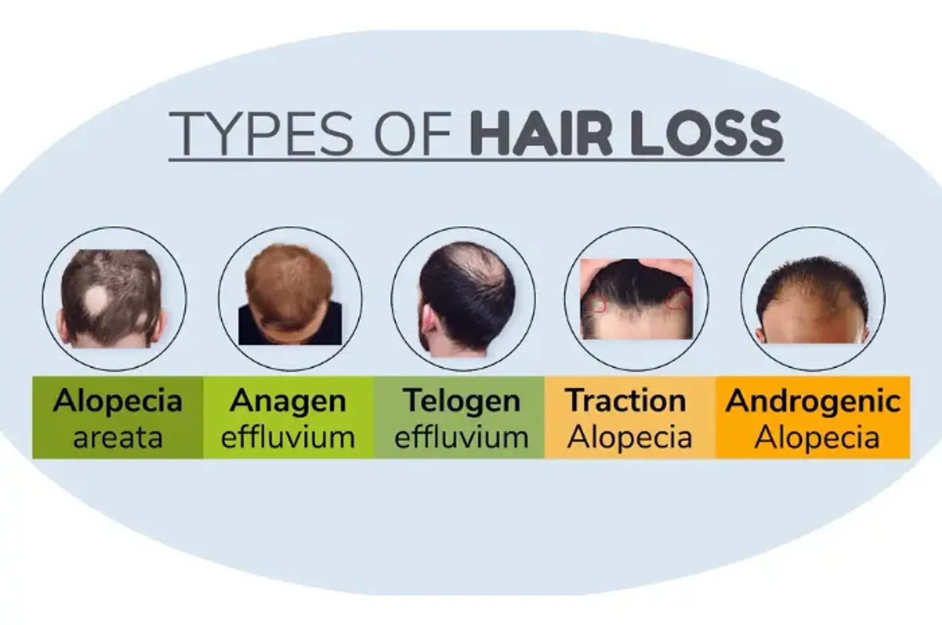 Anxiety and Hair Loss - Are They Related?