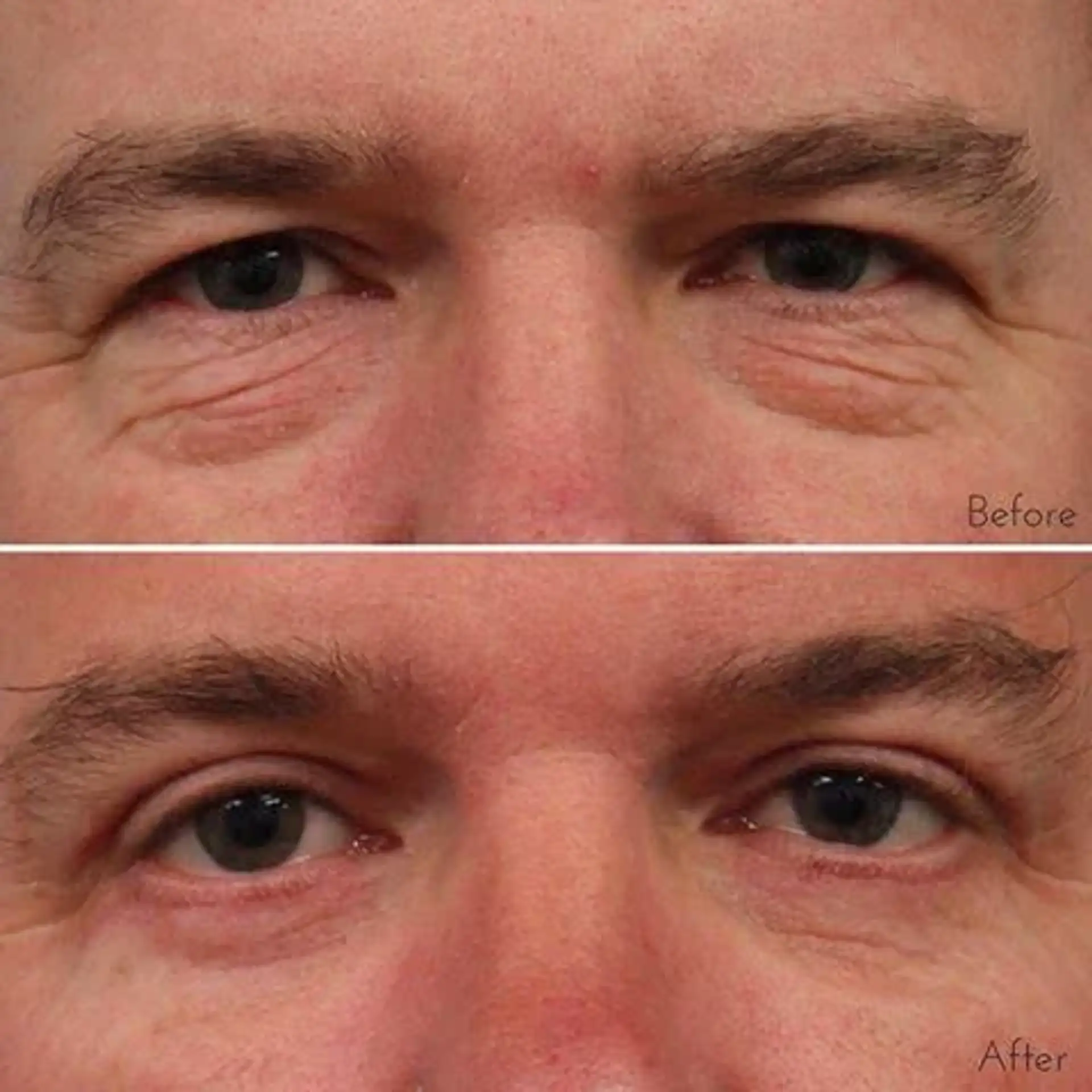 What t Know About Having Eyelid Surgery in Turkey