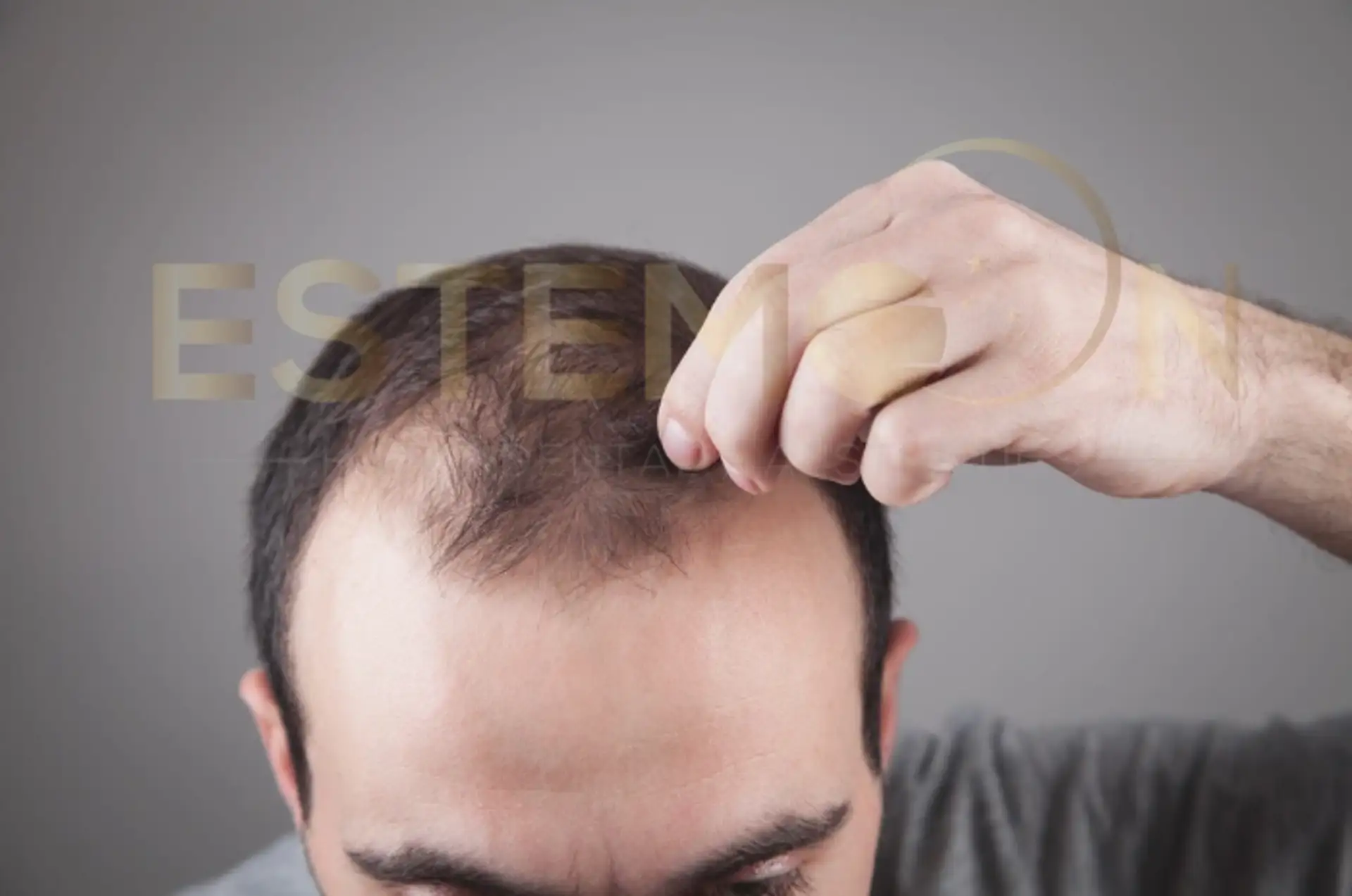 Diagnosing Thyroid Hair Loss and Ruling Out Other Causes
