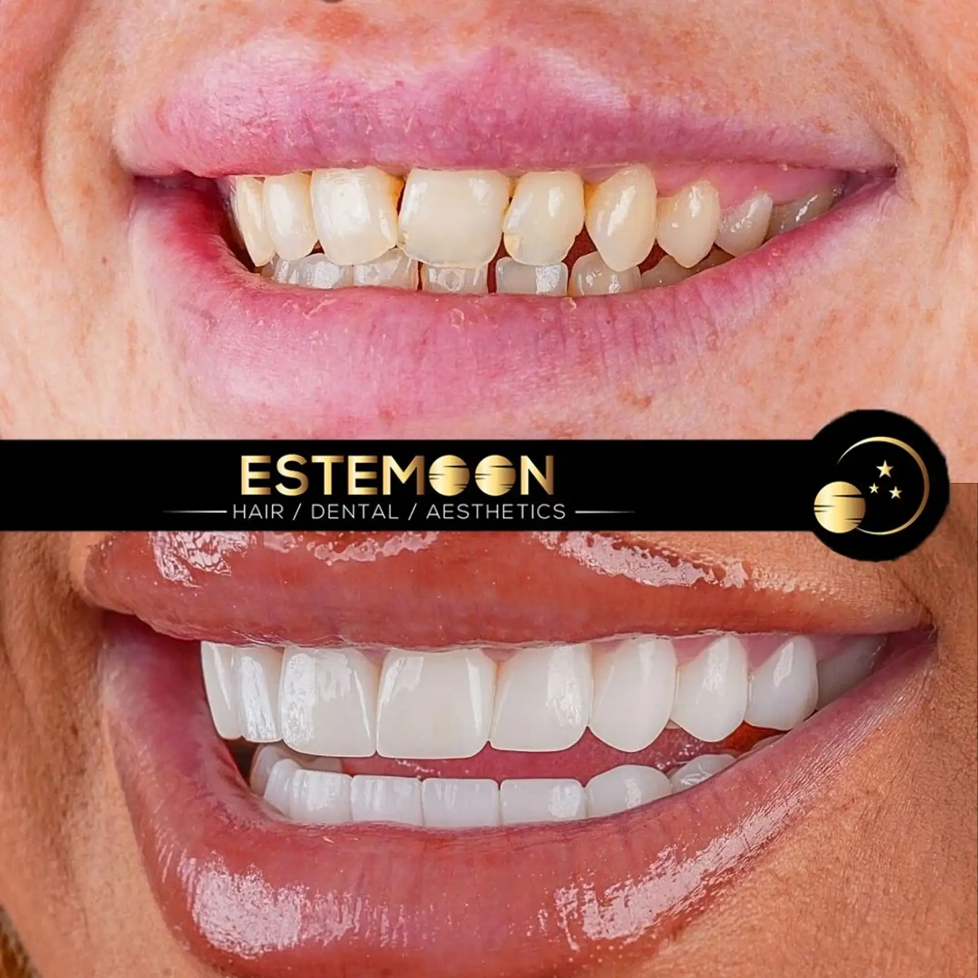 Dental Sedation Options in Albania