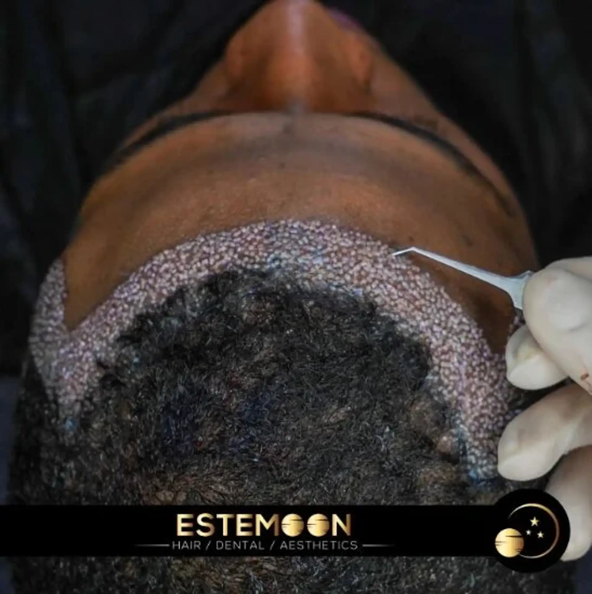 Hair Transplant Recovery Time: What to Know Before Going to Albania