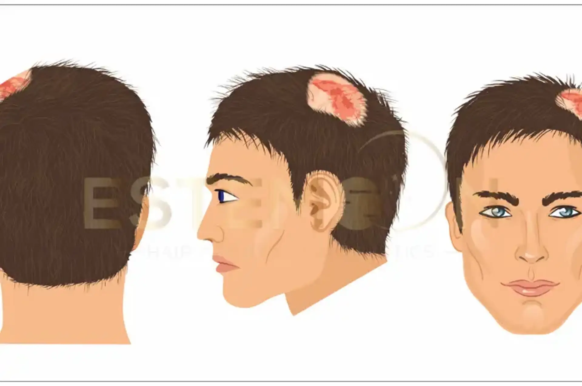 Understanding Scarring Alopecia Diagnosis