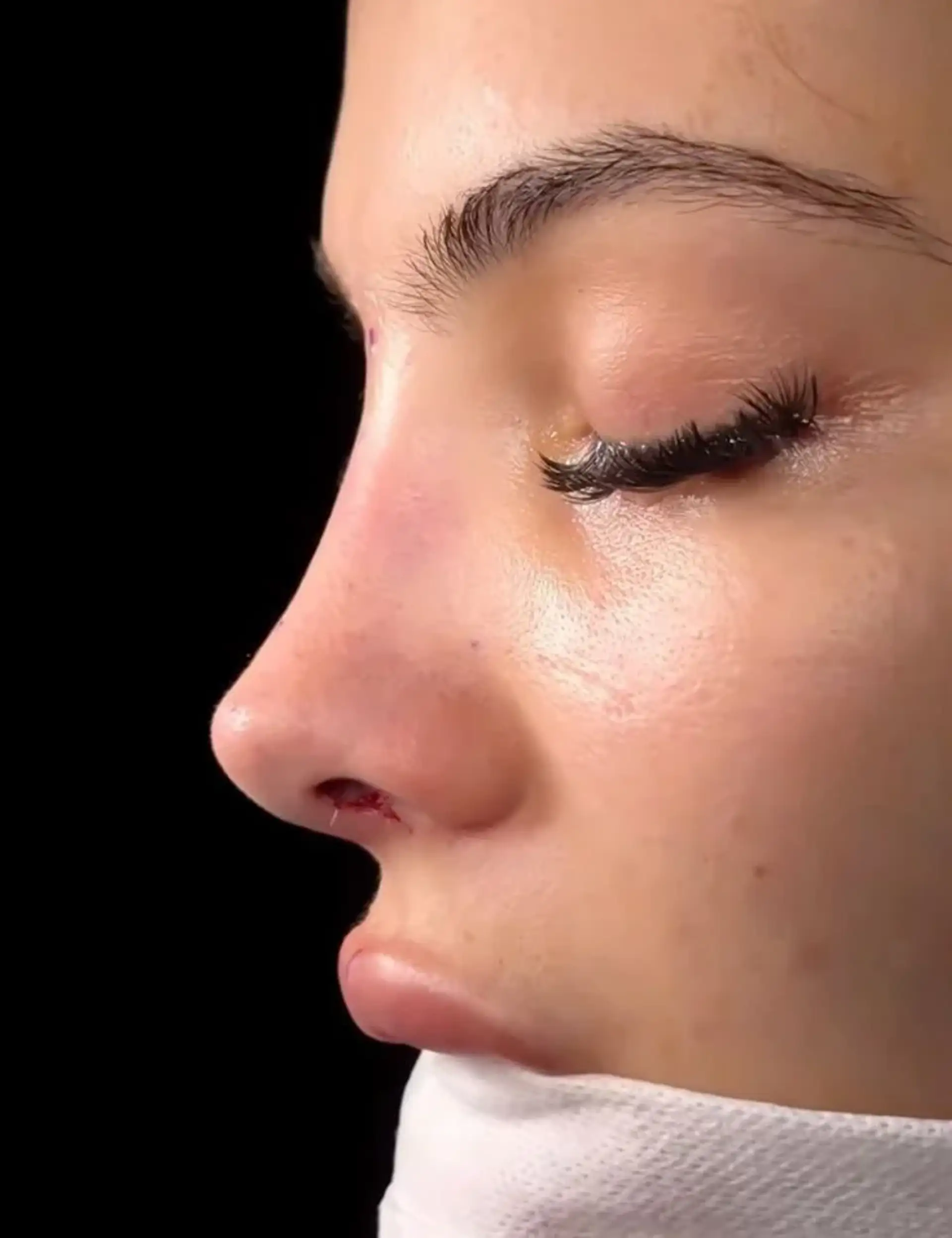 Rhinoplasty in Turkey: Get Your Nose Surgery Abroad