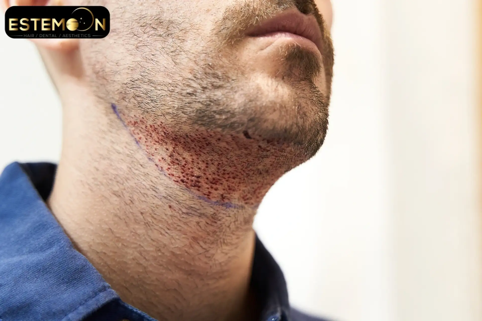 What Are the Costs of Beard Transplant in Turkey?