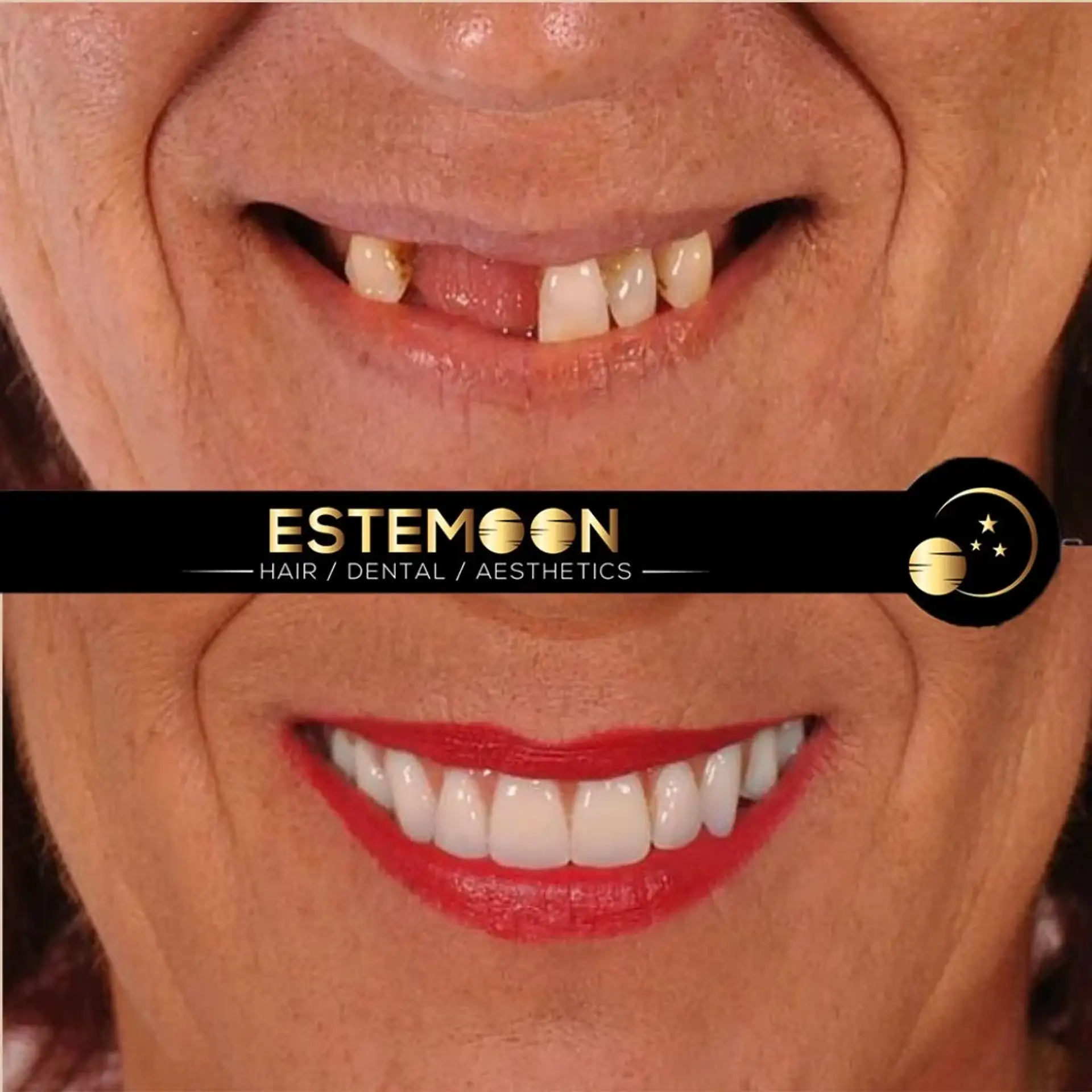 Dental Procedures in Albania: Types of Treatment