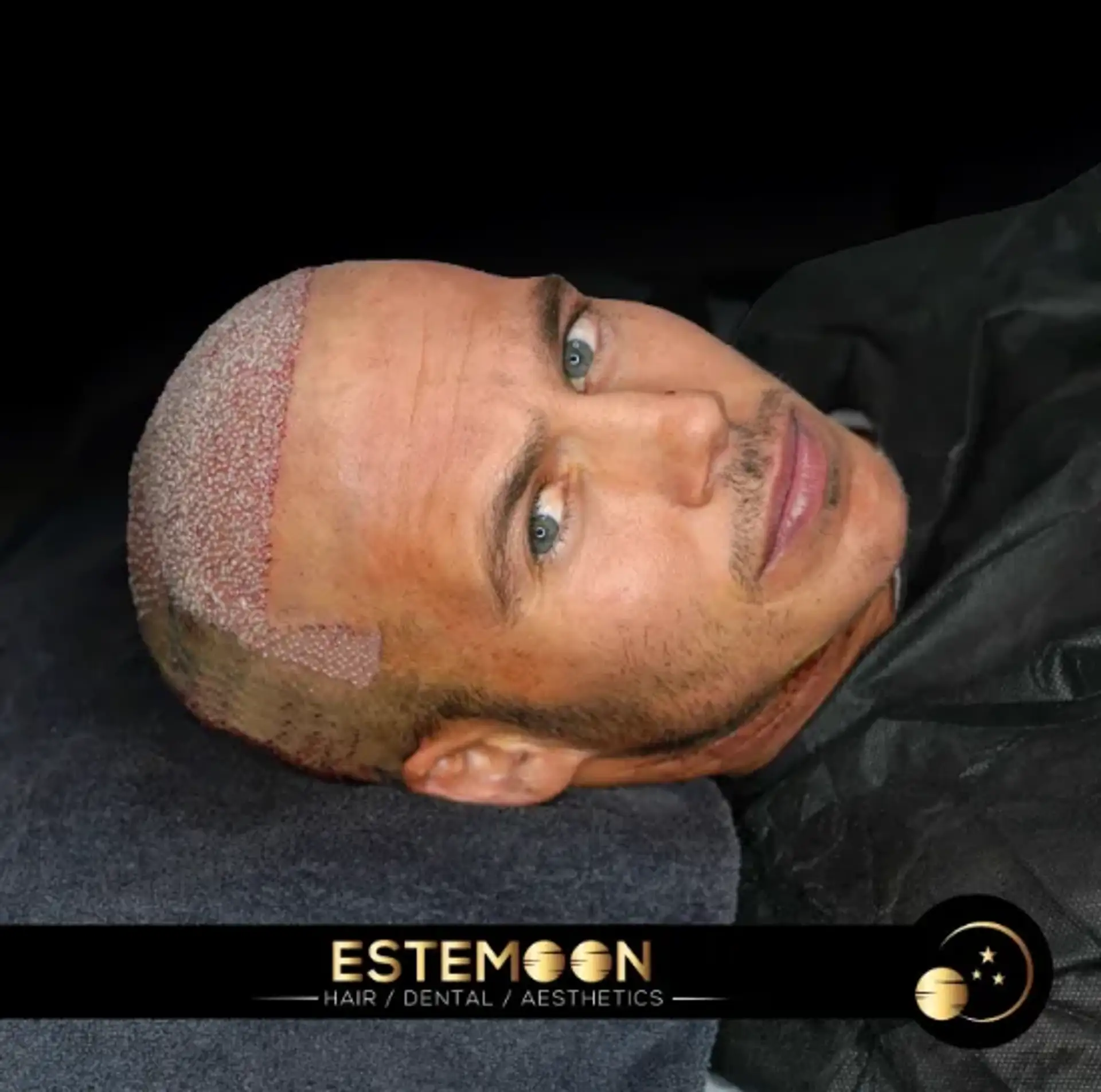FUE Transplant in Albania: Your Way to Hair Restoration