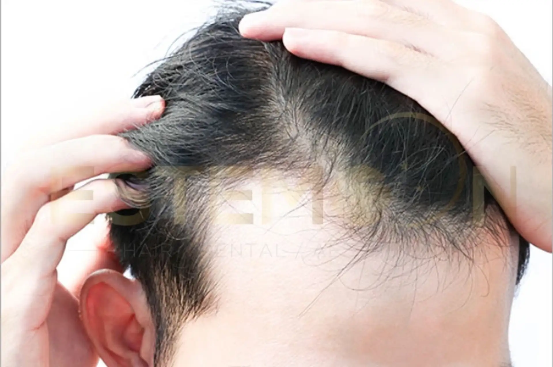 Telogen Effluvium Guide to Causes Symptoms and Treatment