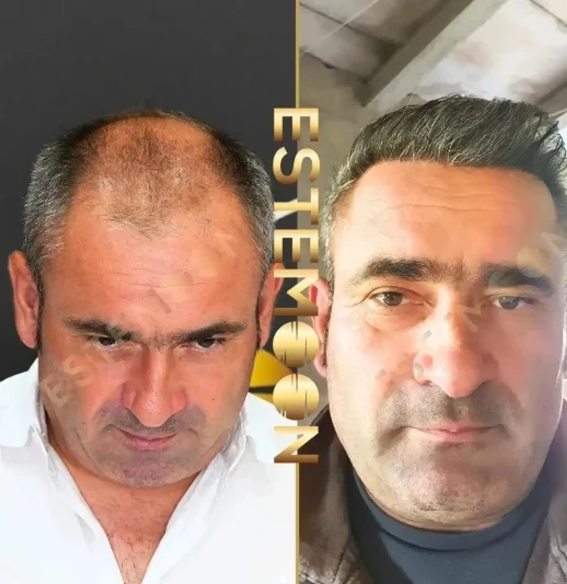 Μεταμόσχευση DHI στην Αλβανία: Αποκατάσταση φυσικών μαλλιών