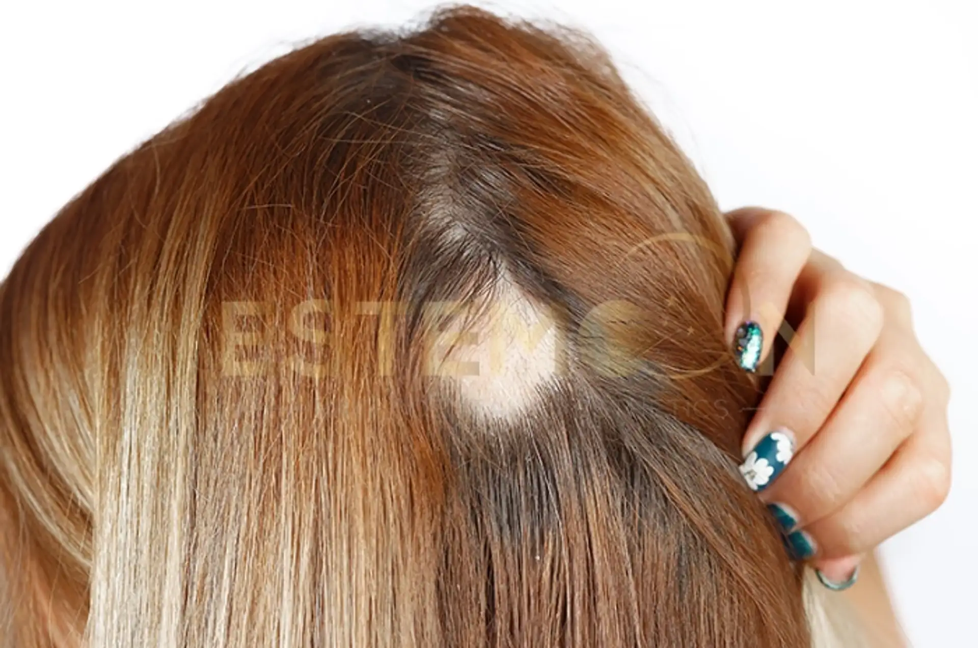 How a Dermatologist Can Help With Hair Loss – Causes and Treatments