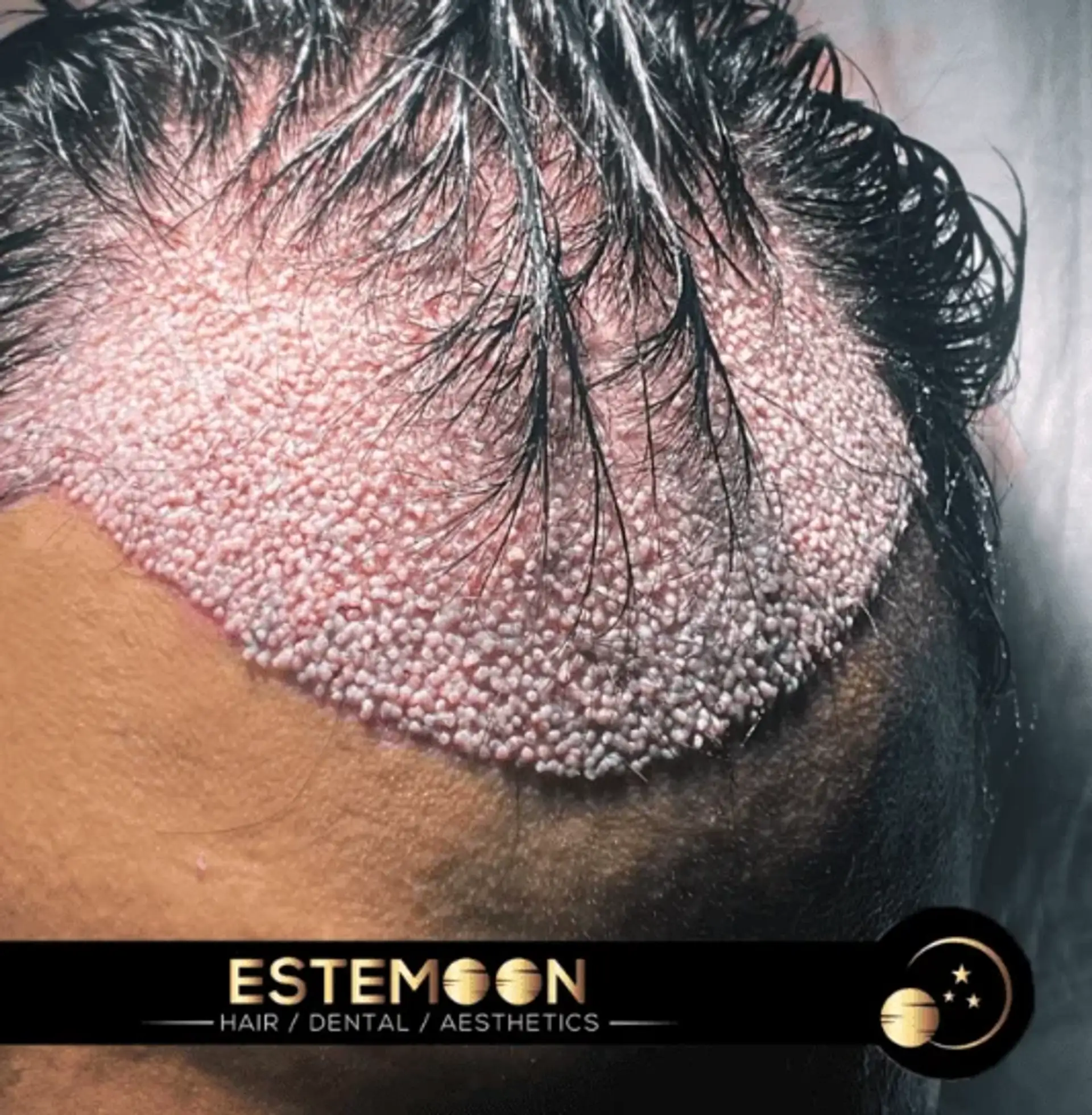 Hair Transplant Eligibility in Albania: A Comprehensive Guide