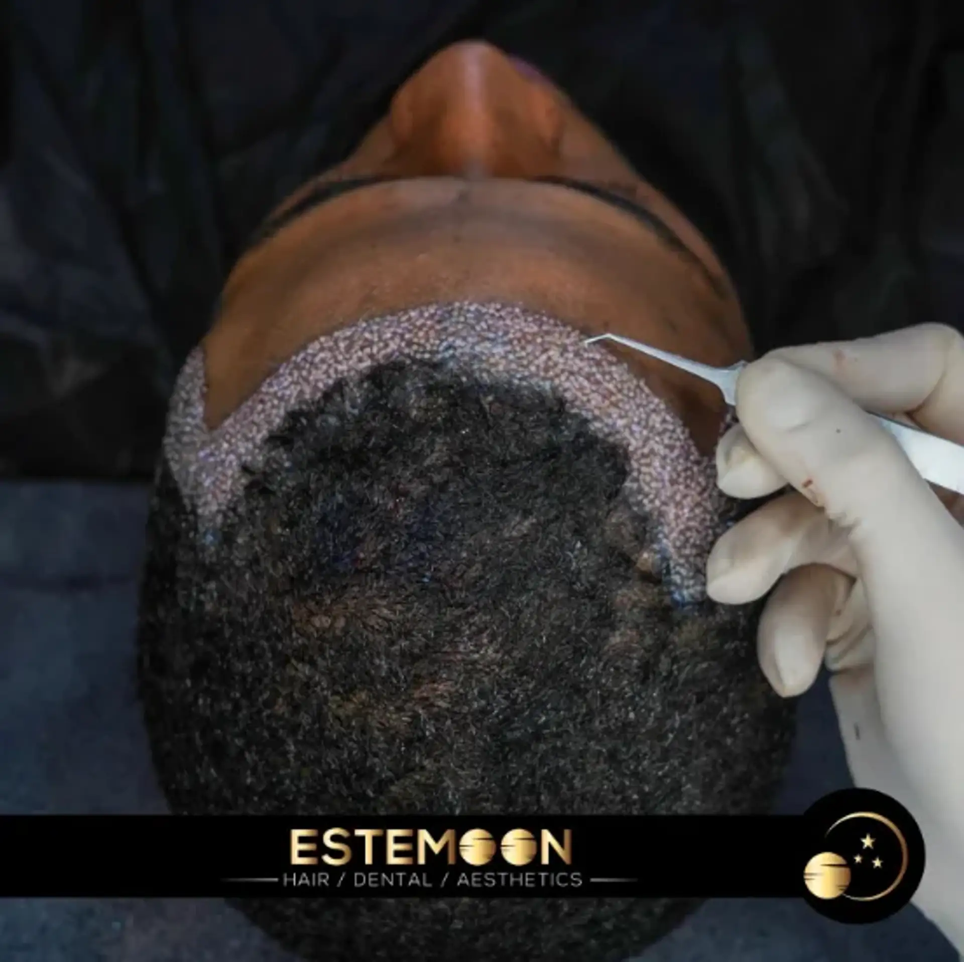 What Can Damage a Hair Transplant?