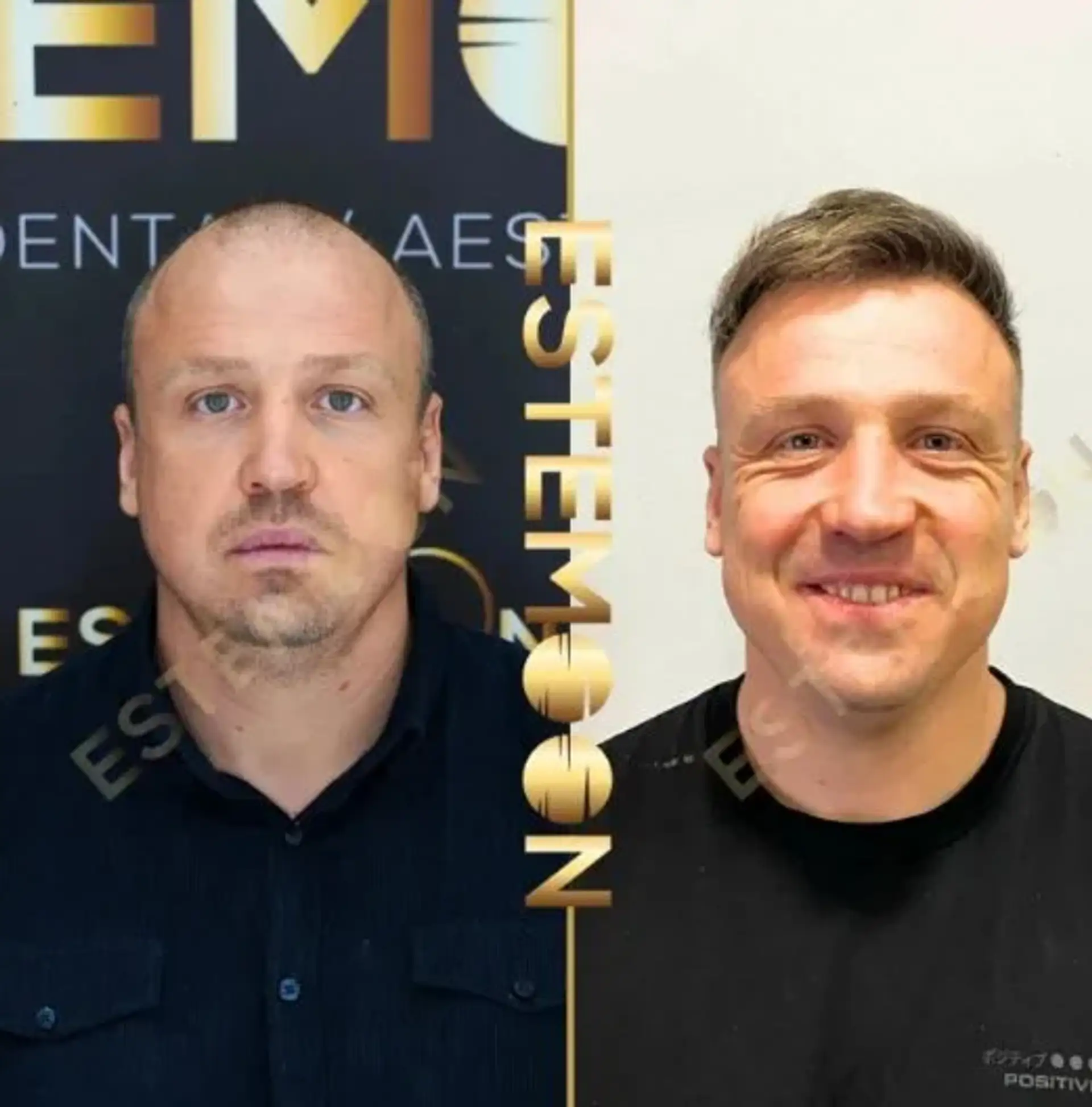 Hair Growth Supplements Post-Transplant