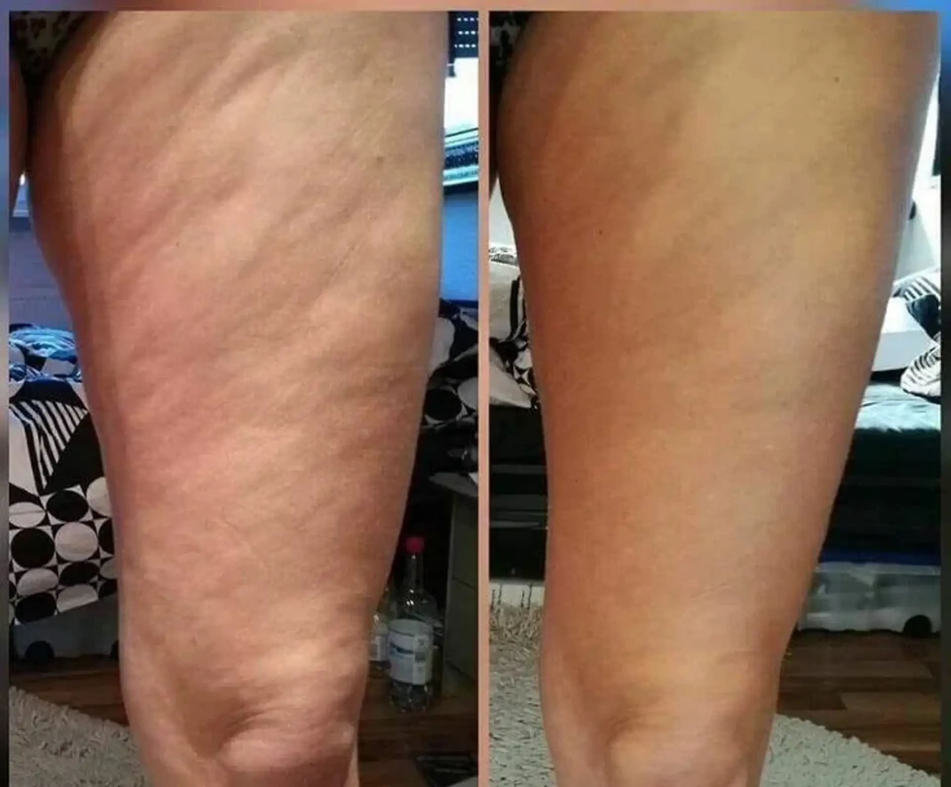 Thigh Lift in Turkey - Get Your Dream Thighs