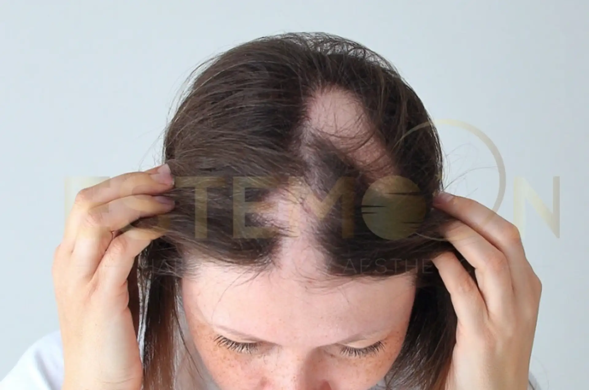 Autoimmune Hair Loss Causes Symptoms and Treatments
