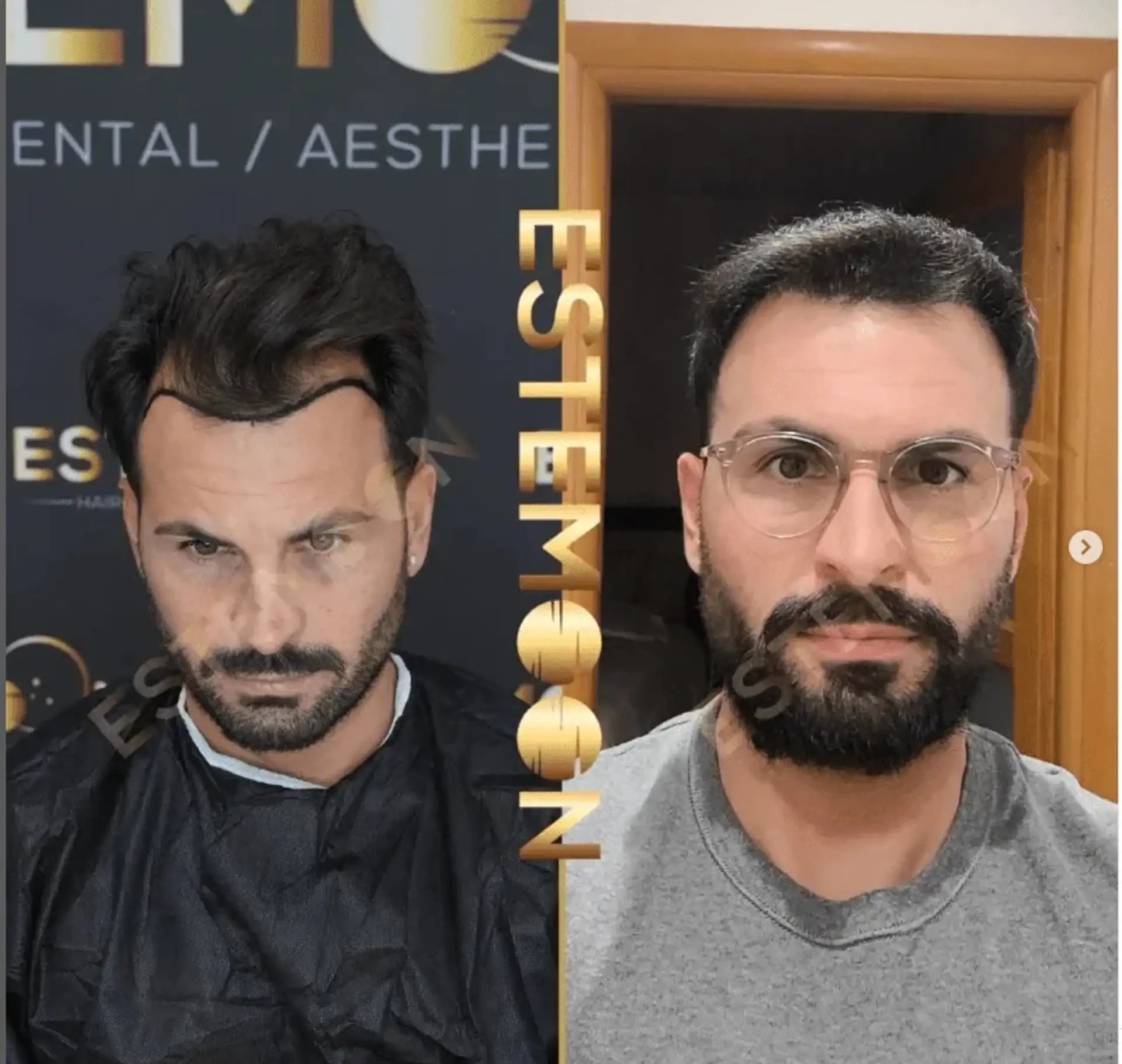 Long-Term Care After Hair Transplant