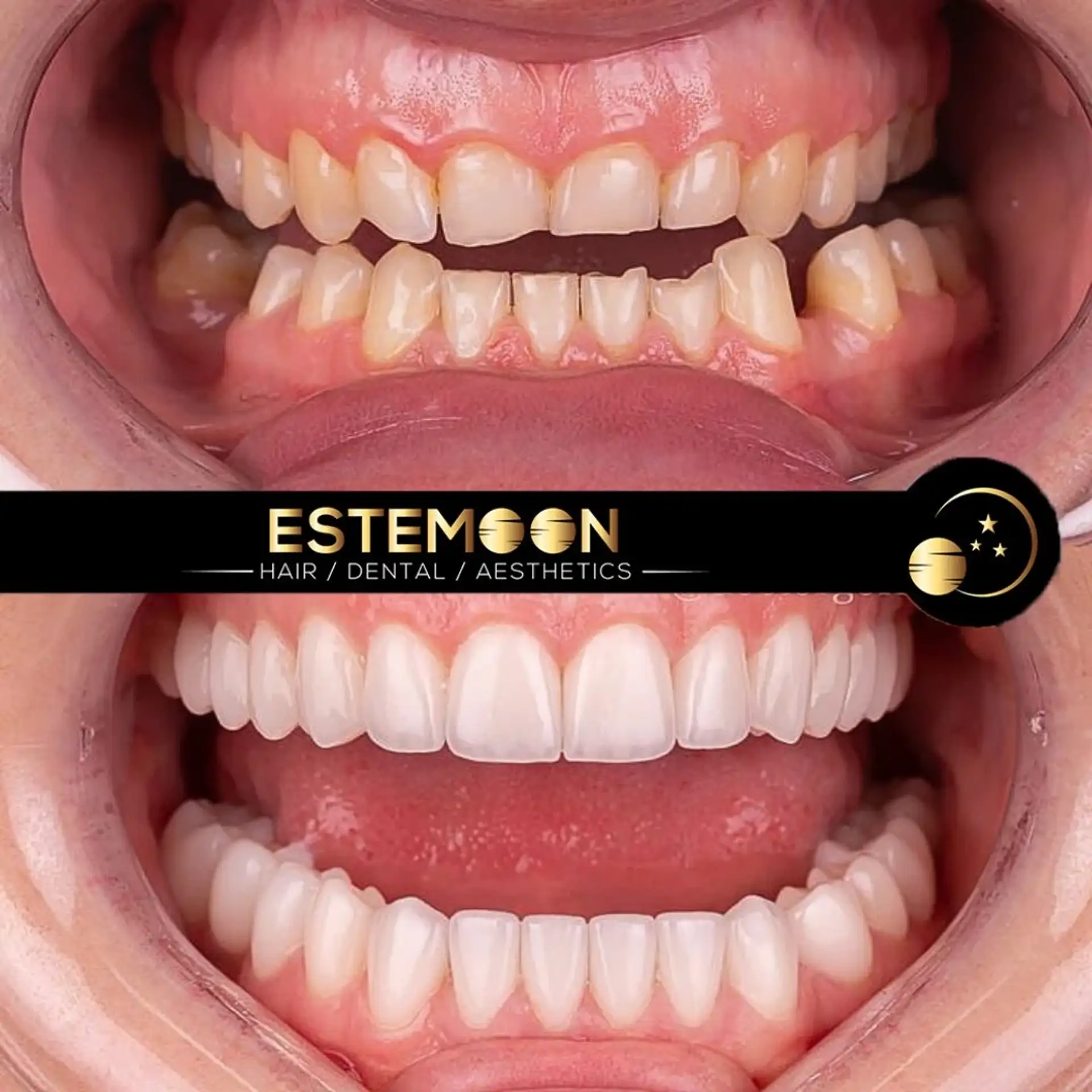 Dental Cleanings in Albania - Professional Care for a Radiant Smile