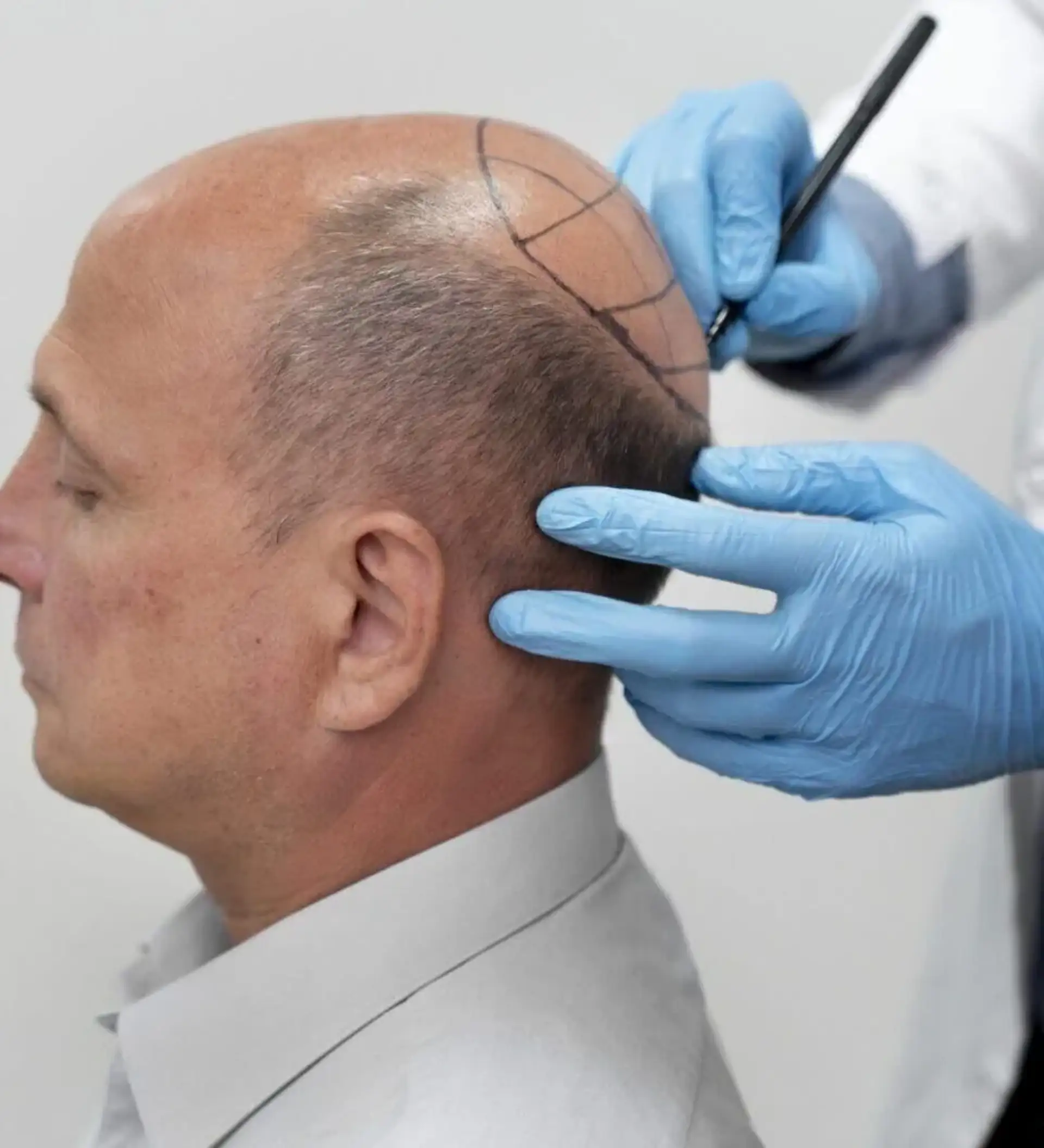 fue-hair-transplant-before-and-after