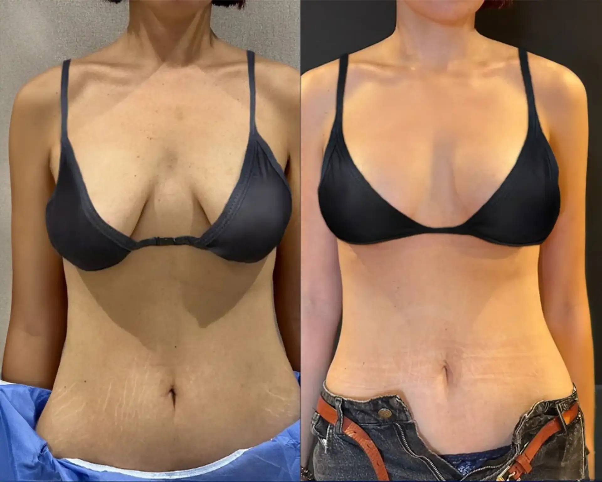 breast-lift-before-after