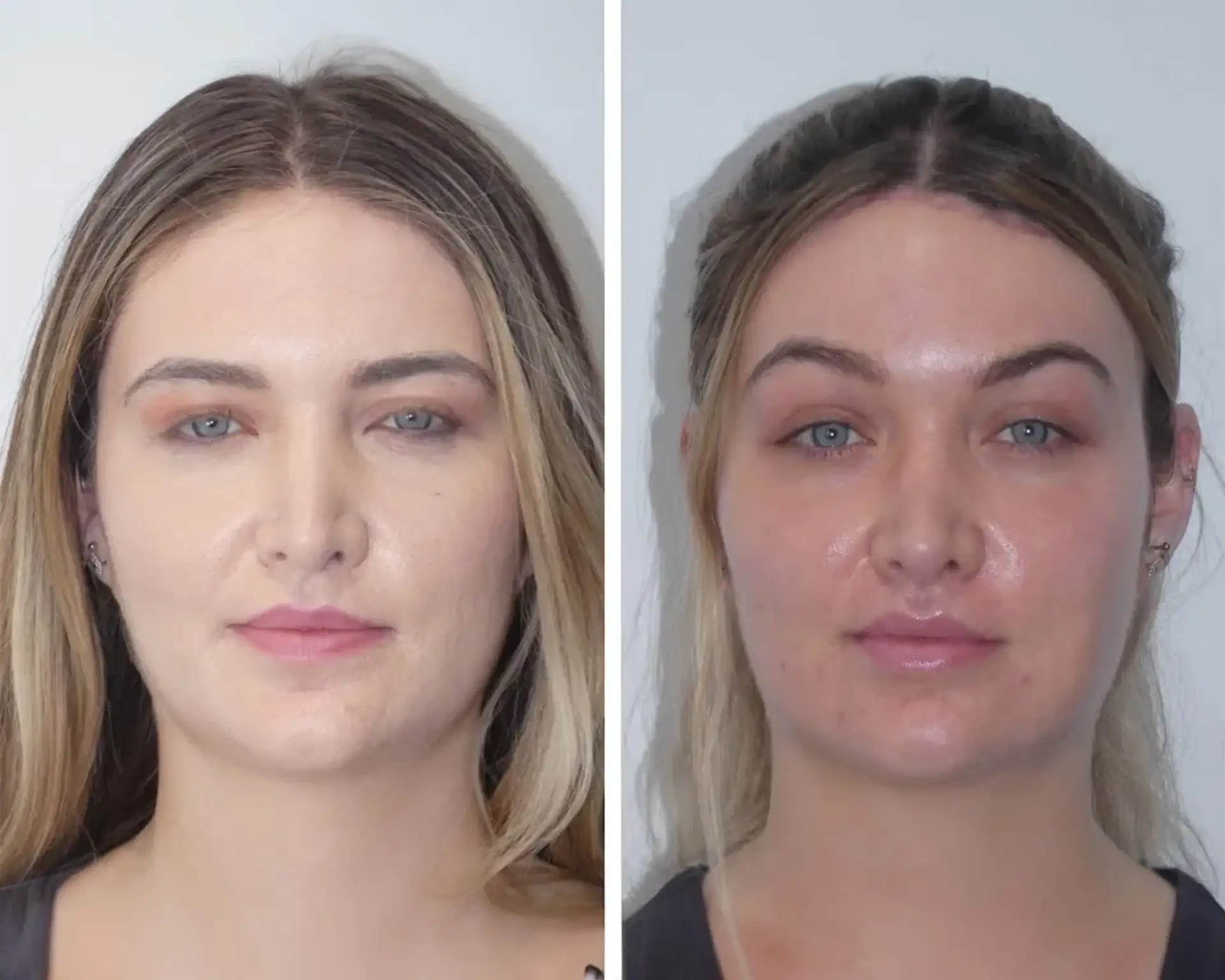 eyebrow-lift