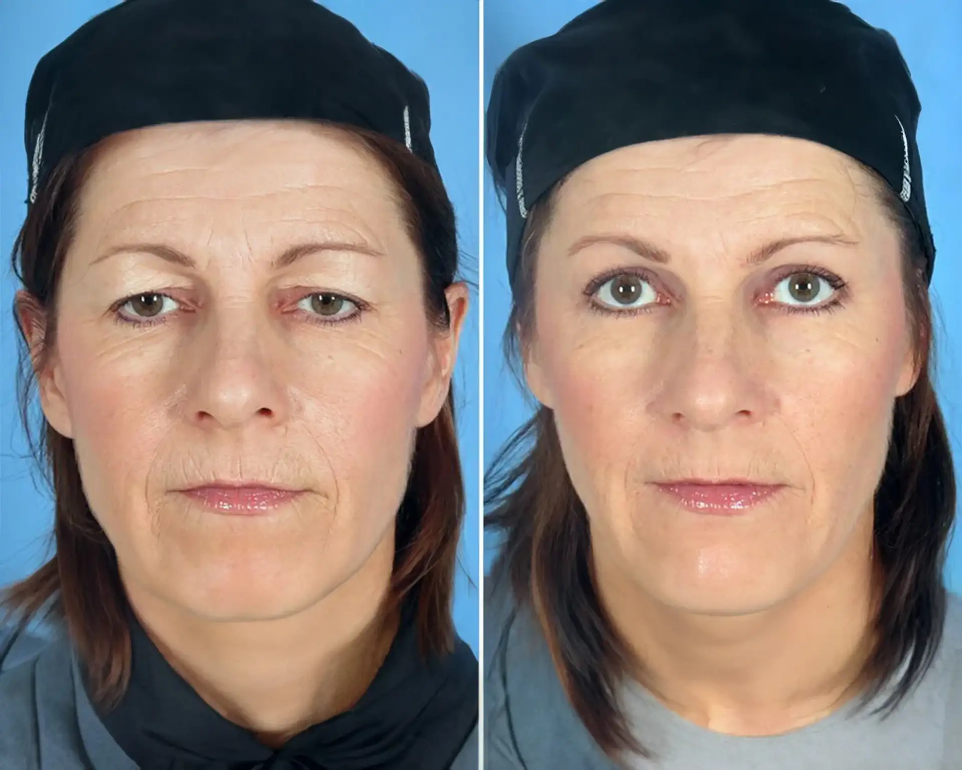 eyelid-surgery-before-and-after