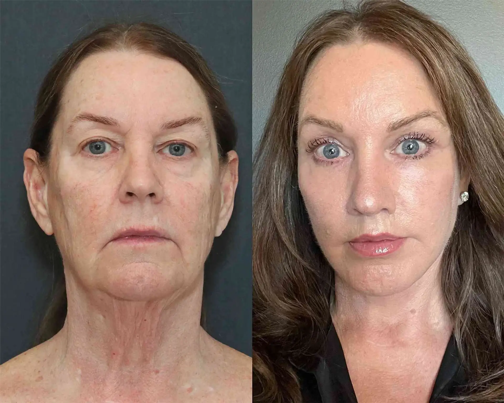 facelift-before-and-after