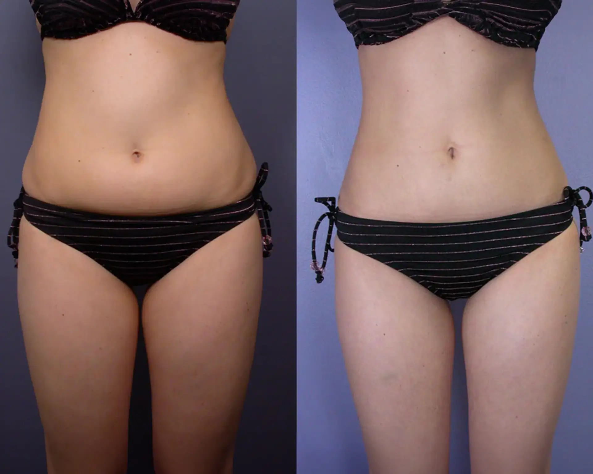 liposuction-before-after