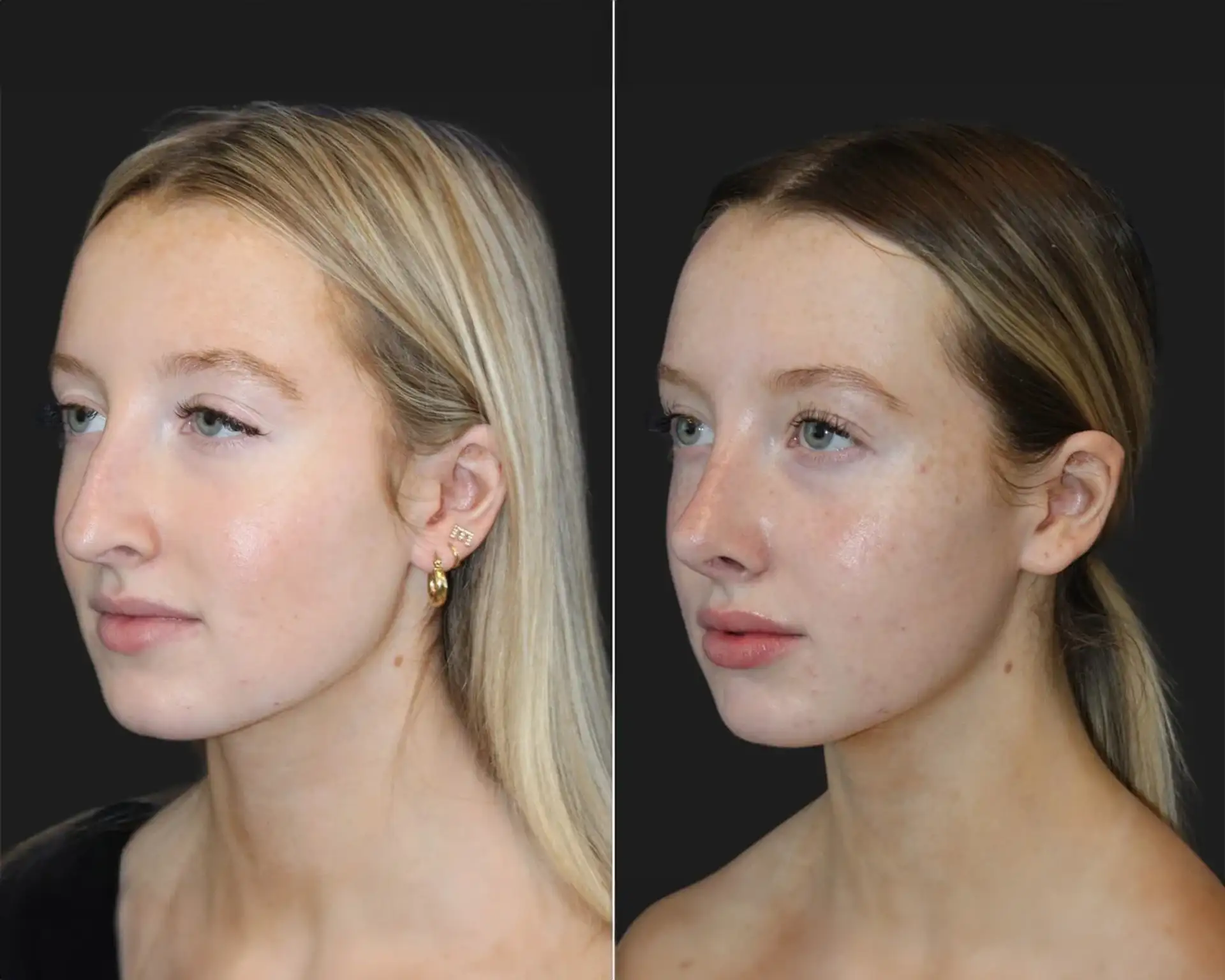 rhinoplasty-before -after