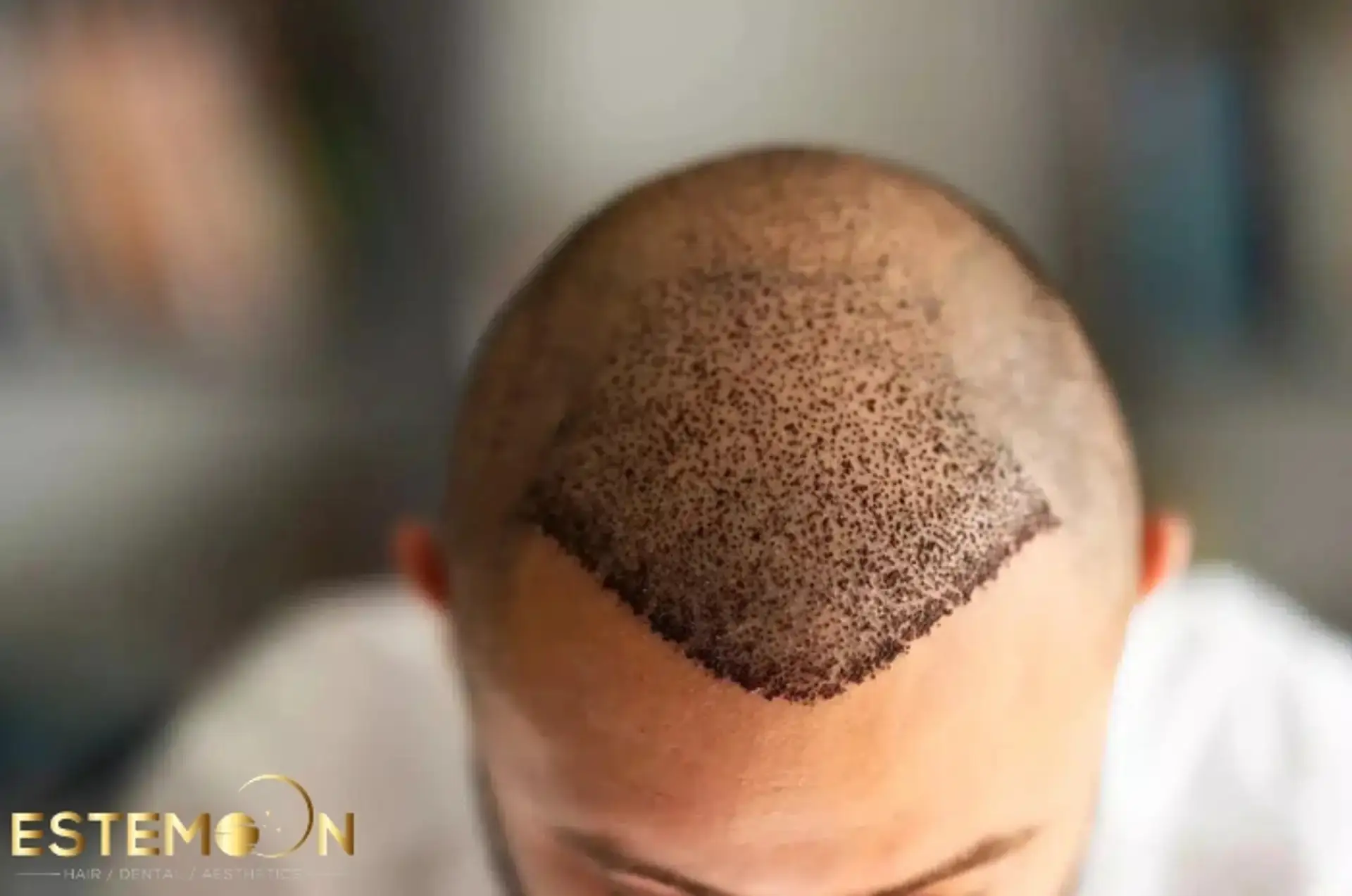 Hair Transplant Before and After Projector