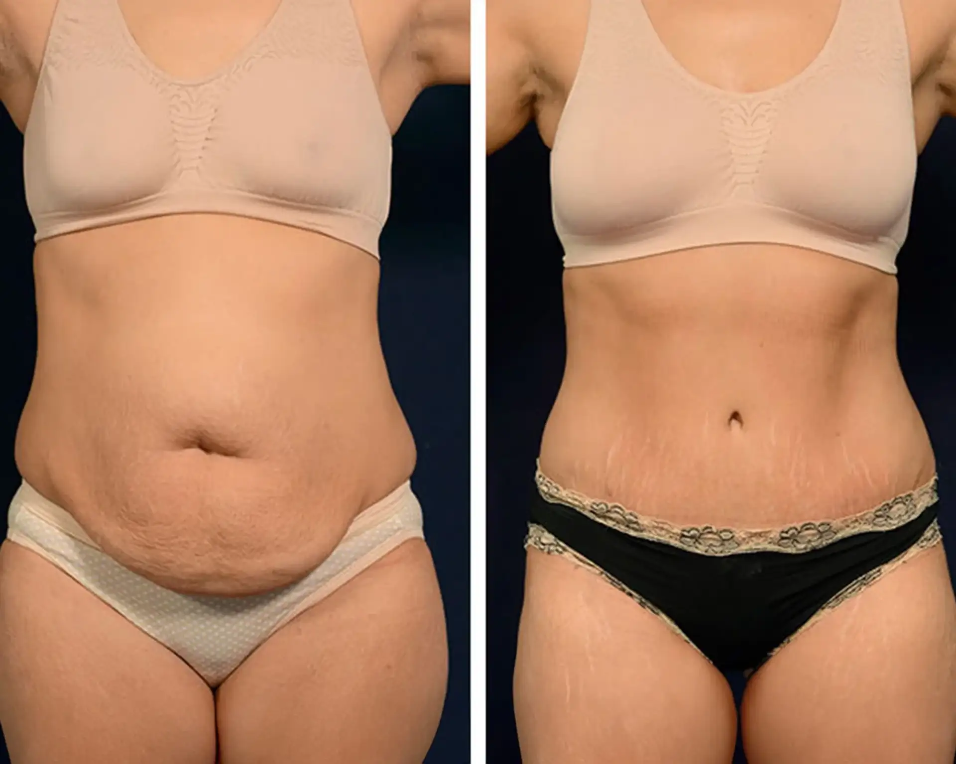 tummy-tuck-before-after