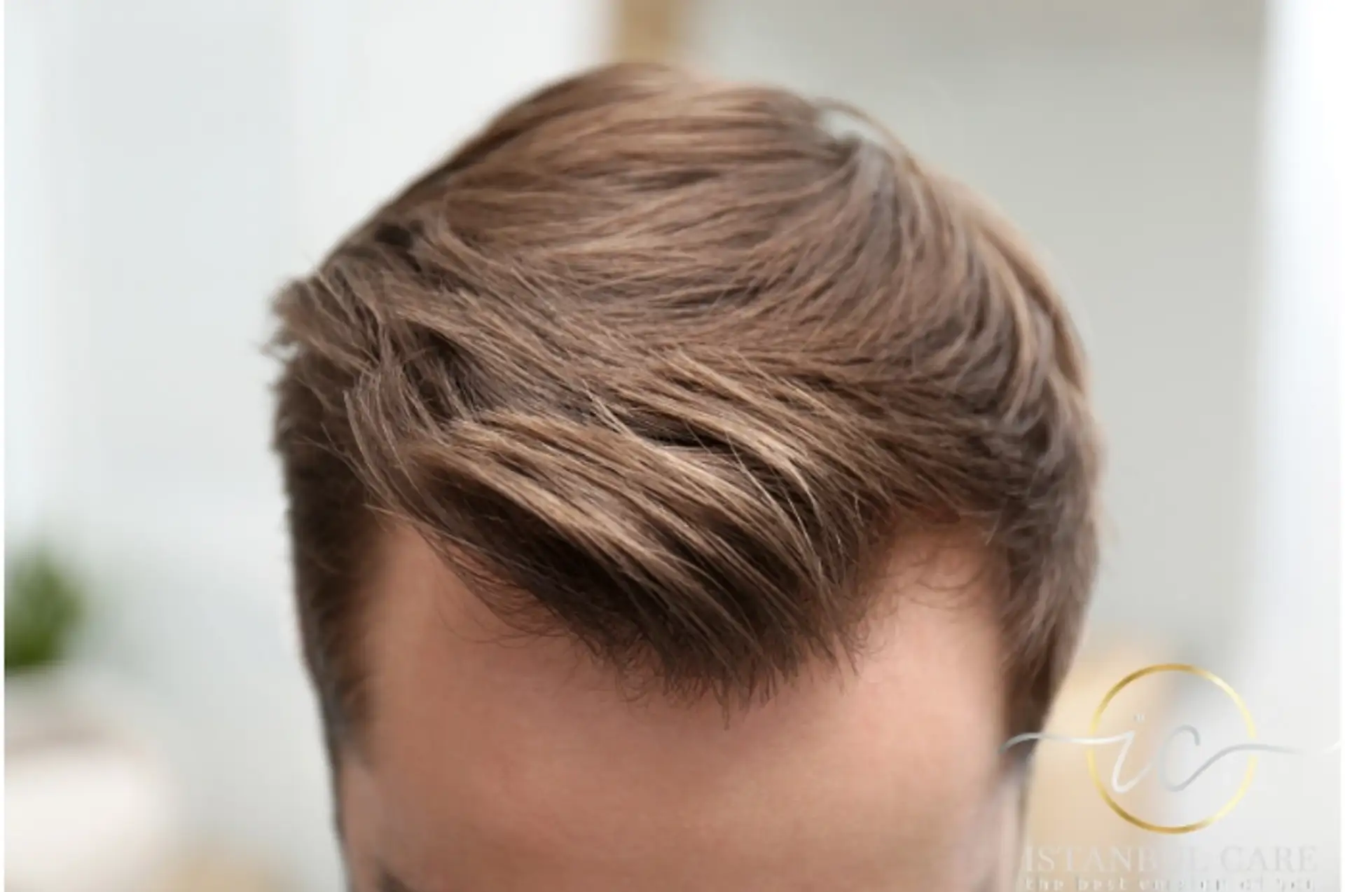 Hair Transplant Before and After Projector