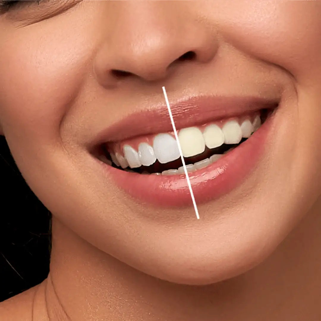 Che cos’è lo sbiancamento dei denti?