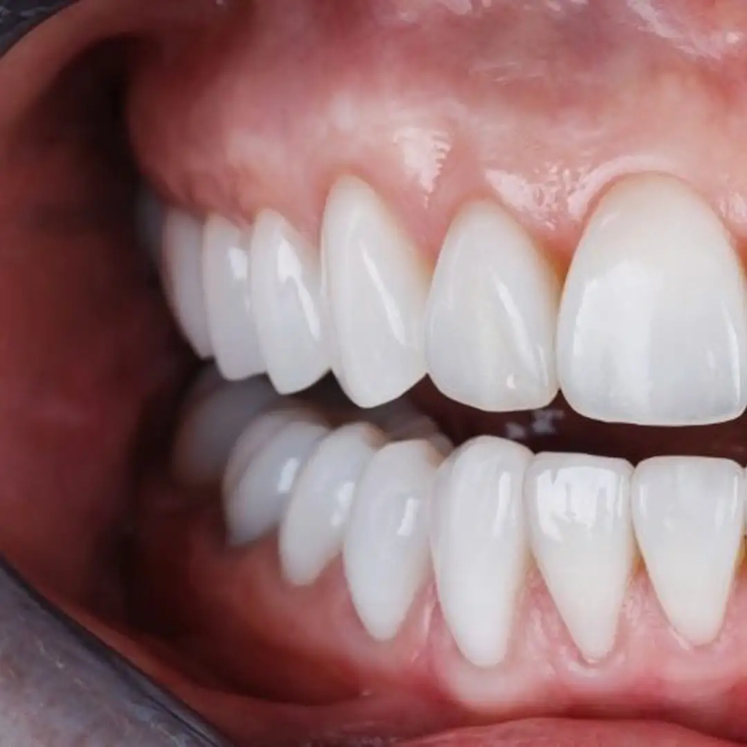 Corone in zirconio Turchia