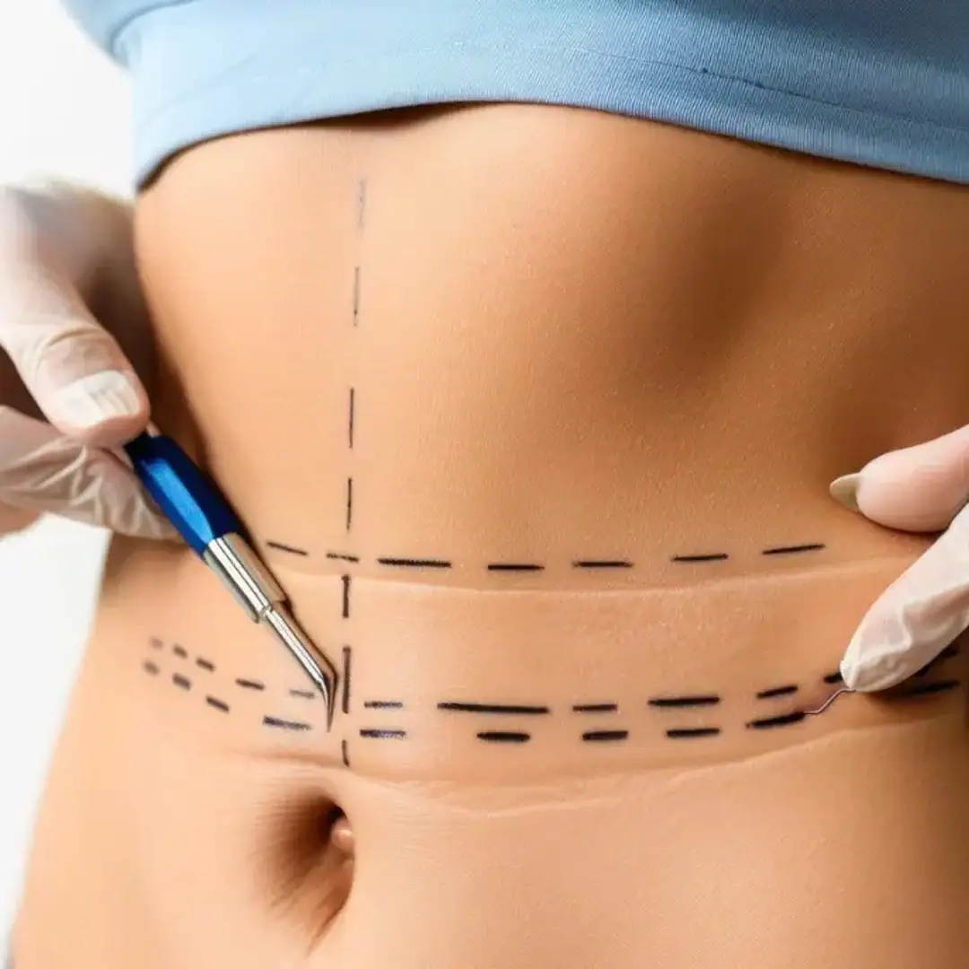 Before Liposuction