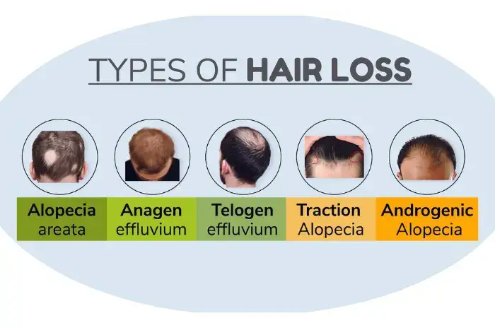 Anxiety and Hair Loss - Are They Related?